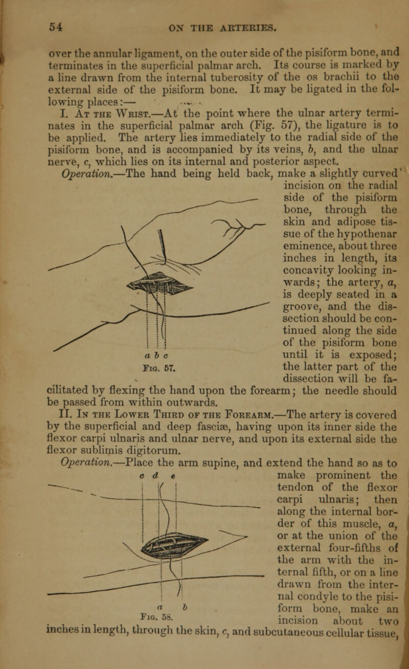 over the annular ligament, on the outer side of the pisiform bone, and terminates in the superficial palmar arch. Its course is marked by a line drawn from the internal tuberosity of the os brachii to the external side of the pisiform bone. It may be ligated in the fol- lowing places:— I. At the Wrist.—At the point where the ulnar artery termi- nates in the superficial palmar arch (Fig. 57), the ligature is to be applied. The artery lies immediately to the radial side of the pisiform bone, and is accompanied by its veins, b, and the ulnar nerve, c, which lies on its internal and posterior aspect. Operation.—The hand being held back, make a slightly curved incision on the radial side of the pisiform bone, through the skin and adipose tis- sue of the hypothenar eminence, about three inches in length, its concavity looking in- wards ; the artery, o, is deeply seated in a groove, and the dis- section should be con- tinued along the side of the pisiform bone ah c until it is exposed; Fig. 67. the latter part of the dissection will be fa- cilitated by flexing the hand upon the forearm; the needle should be passed from within outwards. II. In the Lower Third of the Forearm.—The artery is covered by the superficial and deep fasciae, having upon its inner side the flexor carpi ulnaris and ulnar nerve, and upon its external side the flexor sublimis digitorum. Operation.—Place the arm supine, and extend the hand so as to e d « make prominent the tendon of the flexor carpi ulnaris; then along the internal bor- der of this muscle, a, or at the union of the external four-fifths of the arm with the in- ternal fifth, or on a line drawn from the inter- nal condyle to the pisi- form bone, make an FlG- 58- incision about two inches in length, through the skin, c, and subcutaneous cellular tissue,