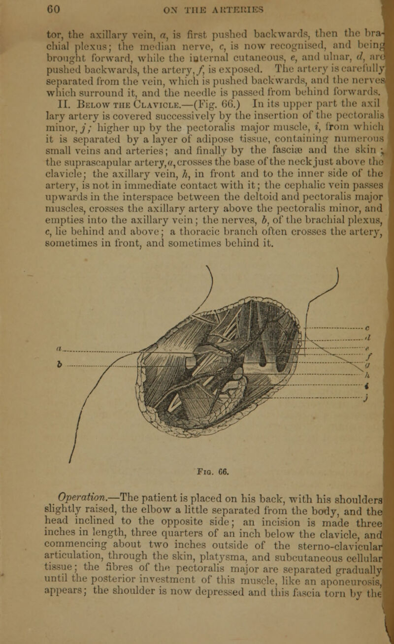 tor, the axillary vein, a, is first pushed backwards, then the bra chial plexus; the median nerve, c, is now recognised, and beinj brought forward, while the iuternal cutaneous, c, and ulnar. </, ar pushed backwards, the artery,/ is exposed. The artery is carel'uilj separated from the vein, which is pushed backwards, and the nerve which surround it, and the needle is passed from behind forwards. II. Below the Clavicle.—(Fig. (S(>.) In its upper part the axil laiy artery is covered successively by the insertion of the pectoralii minor,/; higher up by the pectoralis major muscle, t, from whicl it is separated by a layer of adipose tissue, containing numeroui small veins and arteries; and finally by the fascia:; and the skin the suprascapular artery//, crosses the base of the neck just above lh clavicle; the axillary vein, /;, in front and to the inner side of the artery, is not in immediate contact with it; the cephalic vein passei upwards in the interspace between the deltoid and pectoralis majoi muscles, crosses the axillary artery above the pectoralis minor, am: empties into the axillary vein ; the nerves, b, of the brachial plexus c, lie behind and above; a thoracic branch often crosses the artery, sometimes in front, and sometimes behind it. Fio. C6. Operation.—The patient is placed on his back, with his shouldera slightly raised, the elbow a little separated from the body, and the head inclined to the opposite side; an incision is made three- inches in length, three quarters of an inch below the clavicle, and commencing about two inches outside of the sterno-clavicular articulation, through the skin, platysma, and subcutaneous cellular tissue; the Sbres of the pectoralis major are separated gradually until the posterior investment of this muscle, like mi aponeurosis, appears; the shoulder is now depressed and this fascia torn by the