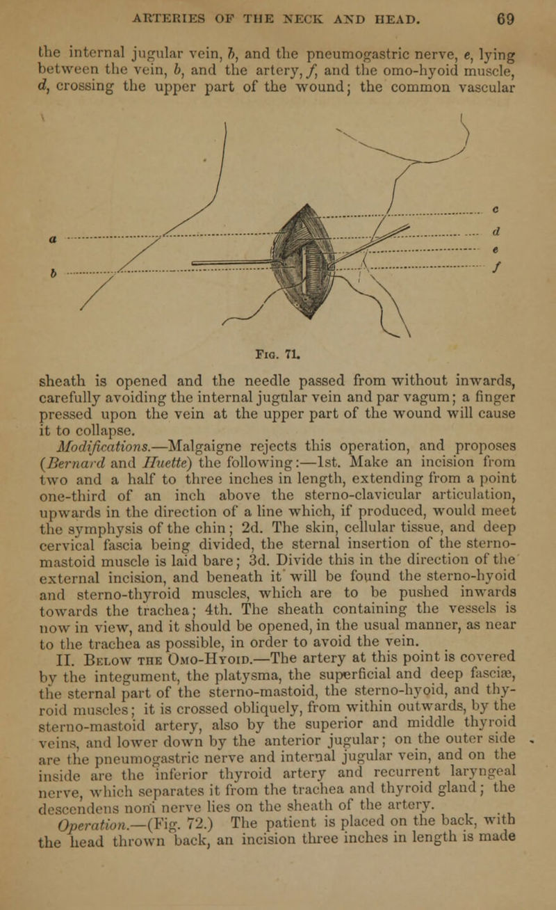 the internal jugular vein, h, and the pneumogastric nerve, e, lying between the vein, b, and the artery,/, and the omo-hyoid muscle, d, crossing the upper part of the wound; the common vascular Fig. 71. sheath is opened and the needle passed from without inwards, carefully avoiding the internal jugular vein and par vagum; a finger pressed upon the vein at the upper part of the wound will cause it to collapse. Modifications.—Malgaigne rejects this operation, and proposes {Bernard and Iludte) the following:—1st. Make an incision from two and a half to three inches in length, extending from a point one-third of an inch above the sterno-clavicular articulation, upwards in the direction of a line which, if produced, would meet the symphysis of the chin; 2d. The skin, cellular tissue, and deep cervical fascia being divided, the sternal insertion of the sterno- mastoid muscle is laid bare; 3d. Divide this in the direction of the external incision, and beneath it' will be found the sterno-hyoid and sterno-thyroid muscles, which are to be pushed inwards towards the trachea; 4th. The sheath containing the vessels is now in view, and it should be opened, in the usual manner, as near to the trachea as possible, in order to avoid the vein. II. Below the Omo-Hvoid.—The artery at this point is covered by the integument, the platysma, the superficial and deep fascia-, the sternal part of the sterno-mastoid, the sterno-hyoid, and thy- roid muscles; it is crossed obliquely, from within outwards, by the sterno-mastoid artery, also by the superior and middle thyroid veins, and lower down by the anterior jugular; on the outer side are the pneumogastric nerve and internal jugular vein, and on the inside are the 'inferior thyroid artery and recurrent laryngeal nerve, which separates it from the trachea and thyroid gland; the descendens noni nerve lies on the sheath of the artery. Operation.—(Fig. 72.) The patient is placed on the back, with the head thrownback, an incision three inches in length is made