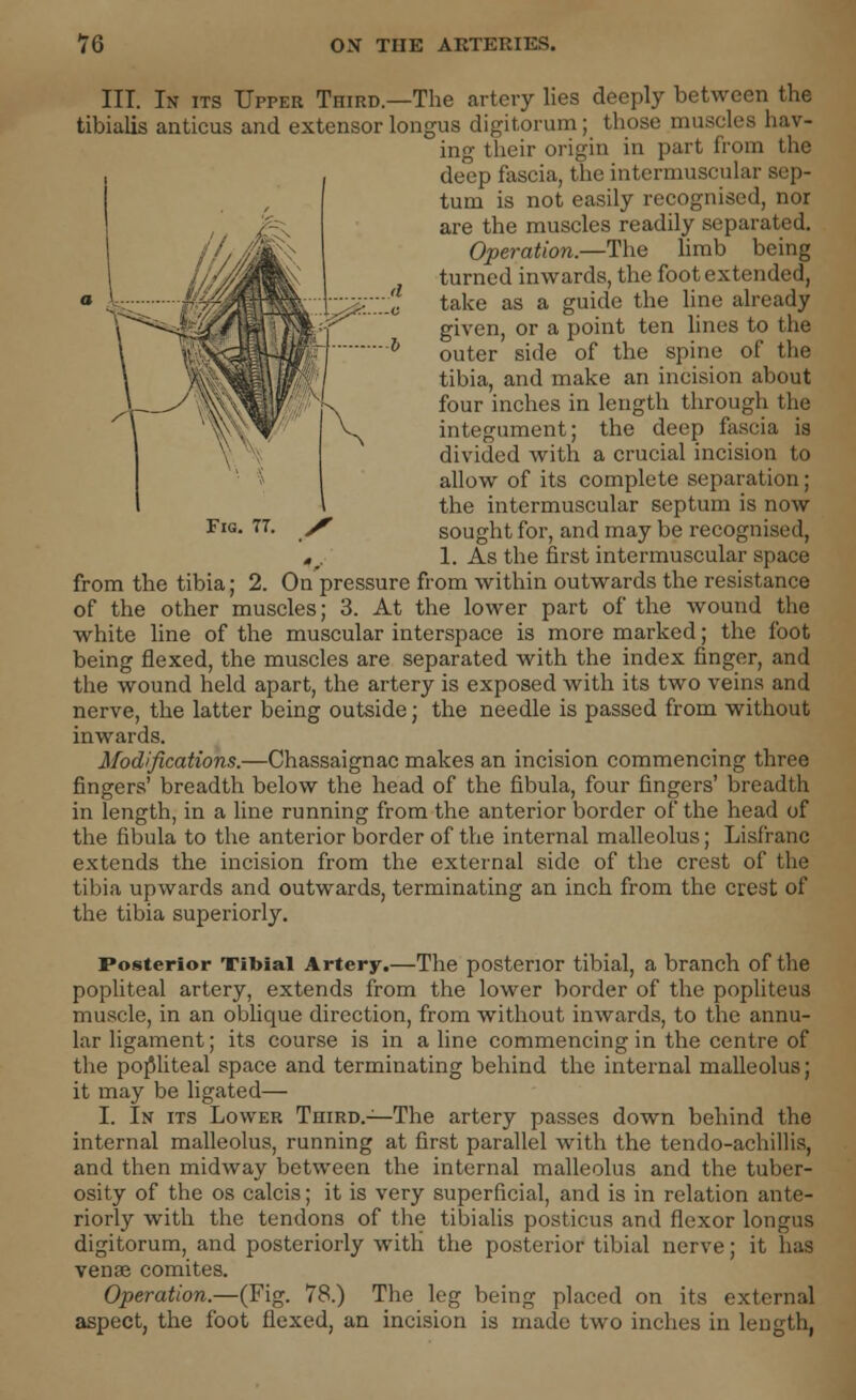 Fig. 77. III. In its Upper Third.—The artery lies deeply between the tibialis anticus and extensor longus digitorum ; those muscles hav- ing their origin in part from the deep fascia, the intermuscular sep- tum is not easily recognised, nor are the muscles readily separated. Operation.—The limb being turned inwards, the foot extended, take as a guide the line already given, or a point ten lines to the outer side of the spine of the tibia, and make an incision about four inches in length through the integument; the deep fascia is divided with a crucial incision to allow of its complete separation; the intermuscular septum is now sought for, and may be recognised, „_ 1. As the first intermuscular space from the tibia; 2. On pressure from within outwards the resistance of the other muscles; 3. At the lower part of the wound the white line of the muscular interspace is more marked; the foot being flexed, the muscles are separated with the index finger, and the wound held apart, the artery is exposed with its two veins and nerve, the latter being outside; the needle is passed from without inwards. Modifications.—Chassaignac makes an incision commencing three fingers' breadth below the head of the fibula, four fingers' breadth in length, in a line running from the anterior border of the head of the fibula to the anterior border of the internal malleolus; Lisfranc extends the incision from the external side of the crest of the tibia upwards and outwards, terminating an inch from the crest of the tibia superiorly. Posterior Tibial Artery.—The posterior tibial, a branch of the popliteal artery, extends from the lower border of the popliteus muscle, in an oblique direction, from without inwards, to the annu- lar ligament; its course is in a line commencing in the centre of the popliteal space and terminating behind the internal malleolus; it may be ligated— I. In its Lower Third.—The artery passes down behind the internal malleolus, running at first parallel with the tendo-achillis, and then midway between the internal malleolus and the tuber- osity of the os calcis; it is very superficial, and is in relation ante- riorly with the tendons of the tibialis posticus and flexor longus digitorum, and posteriorly with the posterior tibial nerve; it has venae comites. Operation.—(Fig. 78.) The leg being placed on its external aspect, the foot flexed, an incision is made two inches in length,