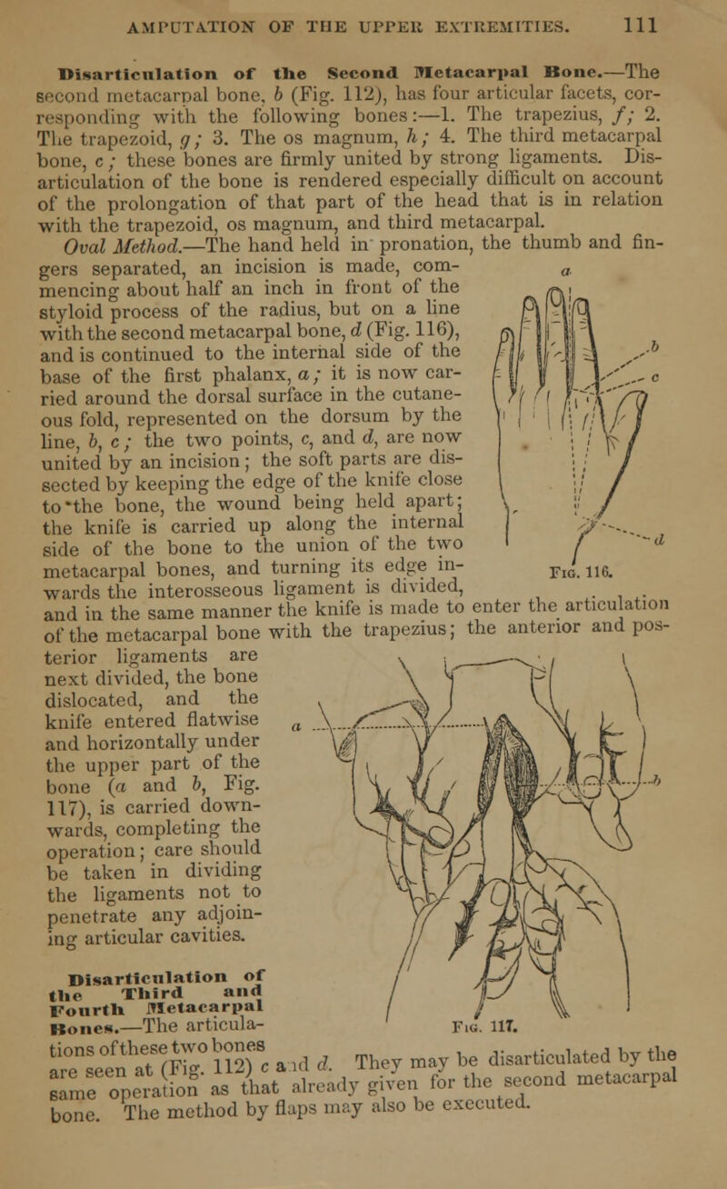 Disarticulation of the Second Metacarpal Bone.—The second metacarpal bone, 6 (Fig. 112), has four articular facets, cor- respond'ing with the following bones:—1. The trapezius, /; 2. The trapezoid, g; 3. The os magnum, h; 4. The third metacarpal bone, c ; these bones are firmly united by strong ligaments. Dis- articulation of the bone is rendered especially difficult on account of the prolongation of that part of the head that is in relation with the trapezoid, os magnum, and third metacarpal. Oval Method.—The hand held in pronation, the thumb and fin- gers separated, an incision is made, com- mencing about half an inch in front of the styloid process of the radius, but on a line with the second metacarpal bone, d (Fig. 116), and is continued to the internal side of the base of the first phalanx, a; it is now car- ried around the dorsal surface in the cutane- ous fold, represented on the dorsum by the line, b, c ; the two points, c, and d, are now united by an incision; the soft parts are dis- sected by keeping the edge of the knife close to*the bone, the wound being held apart; the knife is carried up along the internal side of the bone to the union of the two metacarpal bones, and turning its edge in- wards the interosseous ligament is divided, and in the same manner the knife is made to enter the articulation of the metacarpal bone with the trapezius; the anterior and pos- terior ligaments are next divided, the bone dislocated, and the knife entered flatwise and horizontally under the upper part of the bone (a and b, Fig. 117), is carried down- wards, completing the operation; care should be taken in dividing the ligaments not to penetrate any adjoin- ing articular cavities. Disarticulation of the Third and Fourth Metacarpal Bones.—The articula- SS%5! a .1 d. They may be disarticulated by the sameoperation as that already given for the second metacarpal bone. The method by flaps may also be executed. Flu. 11T.