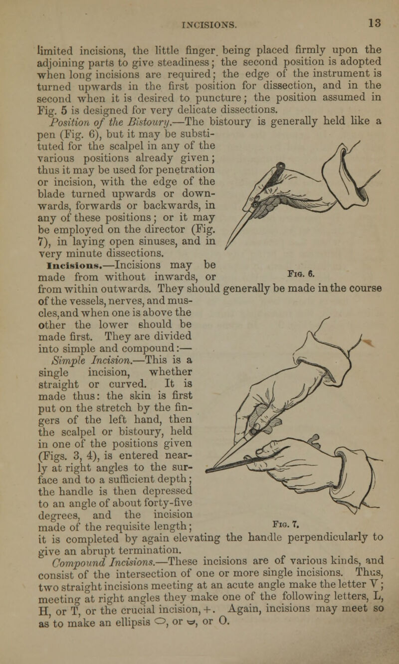 TNCISIONS. limited incisions, the little finger, being placed firmly upon the adjoining parts to give steadiness; the second position is adopted when long incisions are required; the edge of the instrument is turned upwards in the first position for dissection, and in the second when it is desired to puncture; the position assumed in Fig. 5 is designed for very delicate dissections. Position of the Bistoury.—The bistoury is generally held like a pen (Fig. 6), but it may be substi- tuted for the scalpel in any of the various positions already given; thus it may be used for penetration or incision, with the edge of the blade turned upwards or down- wards, forwards or backwards, in any of these positions; or it may be employed on the director (Fig. 7), in laying open sinuses, and in very minute dissections. Incisions.—Incisions may be made from without inwards, or Fis-6- from within outwards. They should generally be made in the course of the vessels, nerves, and mus- cles, and when one is above the other the lower should be made first. They are divided into simple and compound:— Simple Incision.—This is a single incision, whether straight or curved. It is made thus: the skin is first put on the stretch by the fin- gers of the left hand, then the scalpel or bistoury, held in one of the positions given (Figs. 3, 4), is entered near- ly at right angles to the sur- face and to a sufficient depth; the handle is then depressed to an angle of about forty-five degrees, and the incision made of the requisite length; it is completed by again elevating the handle perpendicularly to give an abrupt termination. Compound Incisions.—These incisions are of various kinds, and consist of the intersection of one or more single incisions. Thus, two straight incisions meeting at an acute angle make the letter V; meeting at right angles they make one of the following letters, L, H or T, or the crucial incision, +. Again, incisions may meet so as to make an ellipsis O, or «, or 0. Fio. 7.