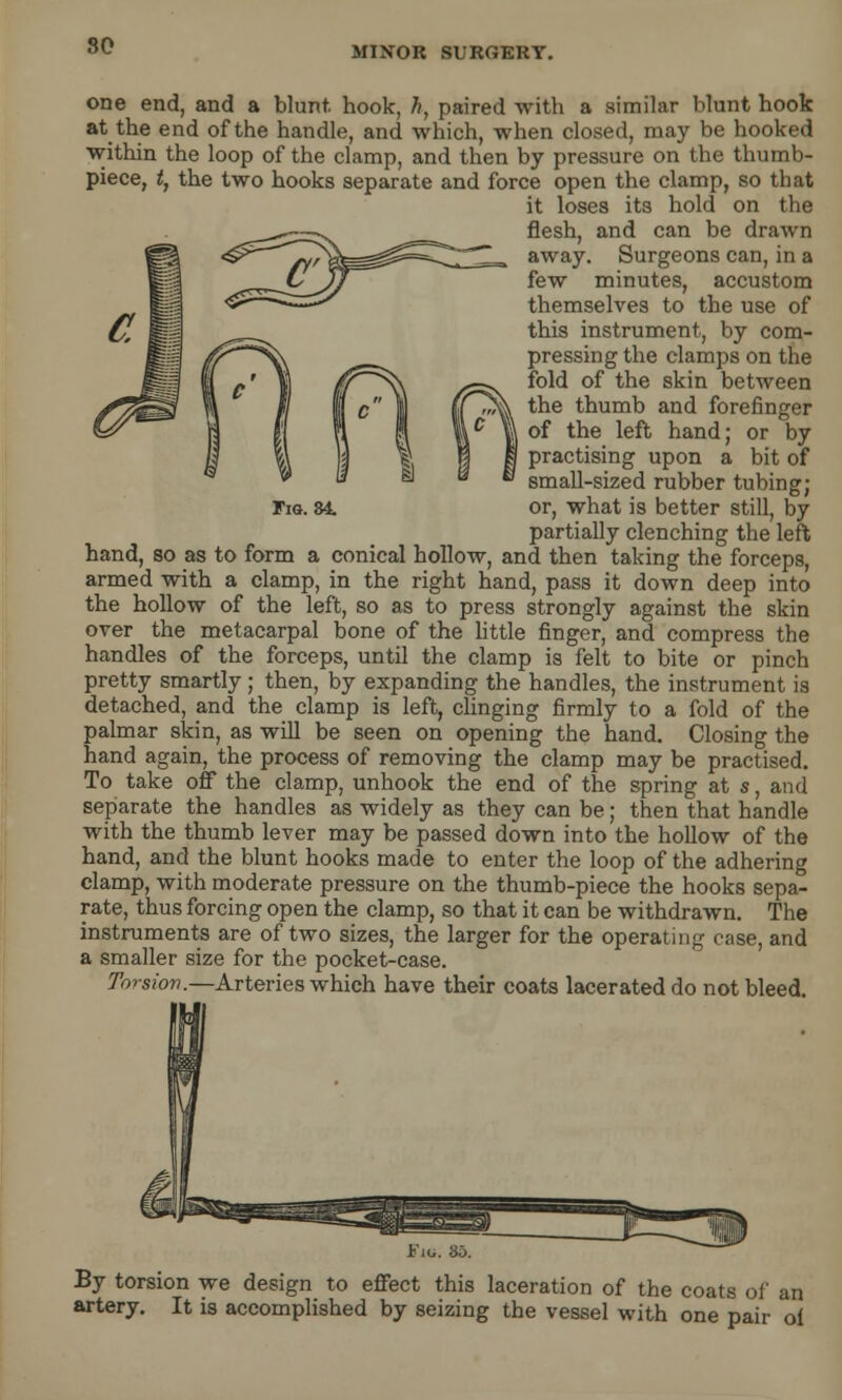 Fig. 84. one end, and a blunt, hook, h, paired with a similar blunt hook at the end of the handle, and which, when closed, may be hooked within the loop of the clamp, and then by pressure on the thumb- piece, t, the two hooks separate and force open the clamp, so that it loses its hold on the flesh, and can be drawn away. Surgeons can, in a few minutes, accustom themselves to the use of this instrument, by com- pressing the clamps on the fold of the skin between the thumb and forefinger of the left hand; or by practising upon a bit of small-sized rubber tubing; or, what is better still, by partially clenching the left hand, so as to form a conical hollow, and then taking the forceps, armed with a clamp, in the right hand, pass it down deep into the hollow of the left, so as to press strongly against the skin over the metacarpal bone of the little finger, and compress the handles of the forceps, until the clamp is felt to bite or pinch pretty smartly; then, by expanding the handles, the instrument is detached, and the clamp is left, clinging firmly to a fold of the palmar skin, as will be seen on opening the hand. Closing the hand again, the process of removing the clamp may be practised. To take off the clamp, unhook the end of the spring at s, and separate the handles as widely as they can be; then that handle with the thumb lever may be passed down into the hollow of the hand, and the blunt hooks made to enter the loop of the adhering clamp, with moderate pressure on the thumb-piece the hooks sepa- rate, thus forcing open the clamp, so that it can be withdrawn. The instruments are of two sizes, the larger for the operating case, and a smaller size for the pocket-case. Torsion.—Arteries which have their coats lacerated do not bleed. Fie. 85 By torsion we design to effect this laceration of the coats of an artery. It is accomplished by seizing the vessel with one pair oi