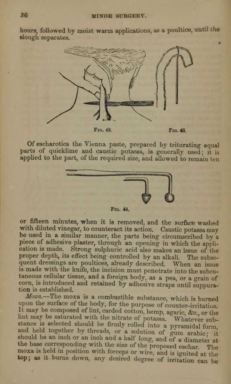 hours, followed by moist warm applications, as a poultice, until (lie slough separates. Fig. 42. Fig. 48. Of escharotics the Vienna paste, prepared by triturating equal parts of quicklime and caustic potassa, is generally used- it is applied to the part, of the required size, and allowed to remain ten Fig. 44. or fifteen minutes, when it is removed, and the surface washed with diluted vinegar, to counteract its action. Caustic potassa may be used in a similar manner, the parts being circumscribed by a piece of adhesive plaster, through an opening in which the appli- cation is made. Strong sulphuric acid also makes an issue of the proper depth, its effect being controlled by an alkali. The subse- quent dressings are poultices, already described. When an issue is made with the knife, the incision must penetrate into the subcu- taneous cellular tissue, and a foreign body, as a pea, or a grain of corn, is introduced and retained by adhesive straps'until suppura- tion is established. Moxa.— The moxa is a combustible substance, which is burned upon the surface of the body, for the purpose of counter-irritation It may be composed of lint, carded cotton, hemp, agaric &c or the lint may be saturated with the nitrate of potassa. Whatever sub- stance is selected should be firmly rolled into a pyramidal form and held together by threads, or a solution of gum arabic ■ it should be an inch or an inch and a half long, and of adiametei at the base corresponding with the size of the proposed eschar The moxa is held in position with forceps or wire, and is ignited'at the top; as it burns down, any desired degree of irritation can be