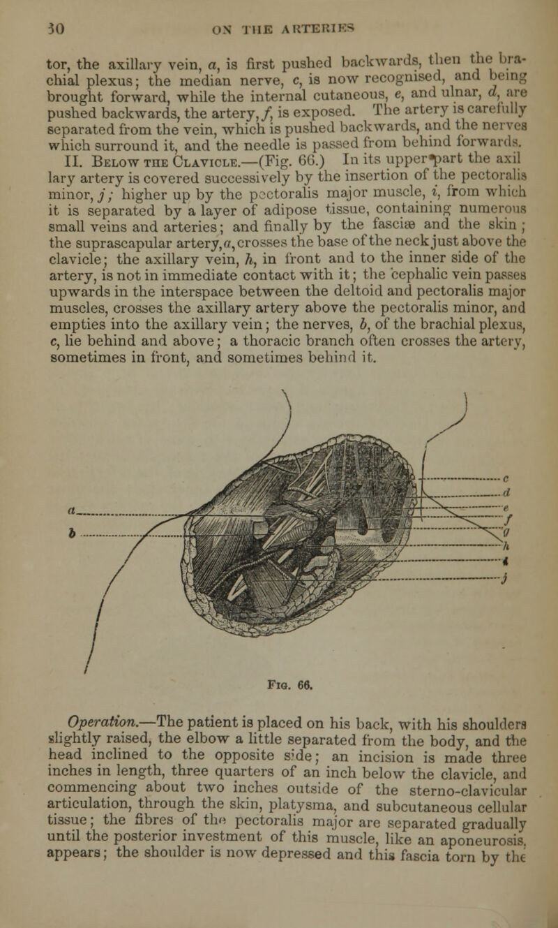 tor, the axillary vein, a, is first pushed backwards, then the bra- chial plexus; the median nerve, c, is now recognised, and bi brought forward, while the internal cutaneous, e, and ulnar, d, are pushed backwards, the artery,/, is exposed. The artery is carefully separated from the vein, which is pushed backwards, and the ne which surround it, and the needle is passed from behind forwards. II. Below the Clavicle.—(Fig. 60.) In its upper^art the axil lary artery is covered successively by the insertion of the pectoralis minor,;'; higher up by the pectoralis major muscle, i, from which it is separated by a layer of adipose tissue, containing numerous small veins and arteries; and finally by the fasciaa and the skin ; the suprascapular artery, ff, crosses the base of the neck just above the clavicle; the axillary vein, h, in front and to the inner side of the artery, is not in immediate contact with it; the cephalic vein passes upwards in the interspace between the deltoid and pectoralis major muscles, crosses the axillary artery above the pectoralis minor, and empties into the axillary vein; the nerves, b, of the brachial plexus, c, he behind and above; a thoracic branch often crosses the artery, sometimes in front, and sometimes behind it. Fio. 66. Operation.—The patient is placed on his back, with his shoulders slightly raised, the elbow a little separated from the body, and the head inclined to the opposite s;de; an incision is made three inches in length, three quarters of an inch below the clavicle, and commencing about two inches outside of the sterno-clavicular articulation, through the skin, platysma, and subcutaneous cellular tissue; the fibres of the pectoralis major are separated gradually until the posterior investment of this muscle, like an aponeurosis, appears; the shoulder is now depressed and this fascia torn by the