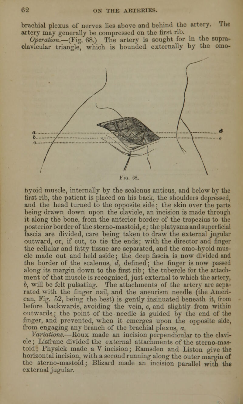 The brachial plexus of nerves lies above and behind the artery. artery may generally be compressed on the first rib. Operation.—(Fig. 68.) The artery is sought for in the supra clavicular triangle, which is bounded externally by the omo hyoid muscle, internally by the scalenus anticus, and below by the first rib, the patient is placed on his back, the shoulders depressed, and the head turned to the opposite side; the skin over the parts being drawn down upon the clavicle, an incision is made through it along the bone, from the anterior border of the trapezius to the posterior border of the sterno-mastoid, e; the platysma and superficial fascia are divided, care being taken to draw the external jugular outward, or, if cut, to tie the ends; with the director and finger the cellular and fatty tissue are separated, and the omo-hyoid mus- cle made out and held aside; the deep fascia is now divided and the border of the scalenus, d, defined; the finger is now passed along its margin down to the first rib; the tubercle for the attach- ment of that muscle is recognised, just external to which the artery, b, will be felt pulsating. The attachments of the artery are sepa- rated with the finger nail, and the aneurism needle (the Ameri- can, Fig. 52, being the best) is gently insinuated beneath it, from before backwards, avoiding the vein, c, and slightly from within outwards; the point of the needle is guided by the end of the finger, and prevented, when it emerges upon the opposite side, from engaging any branch of the brachial plexus, a. Variations.—Roux made an incision perpendicular to the clavi- cle ; Lisfranc divided the external attachments of the sterno-mas- toid ; Physick made a V incision; Ramsden and Liston give the horizontal incision, with a second running along the outer margin of the sterno-mastoid; Blizard made an incision parallel with the external jugular.