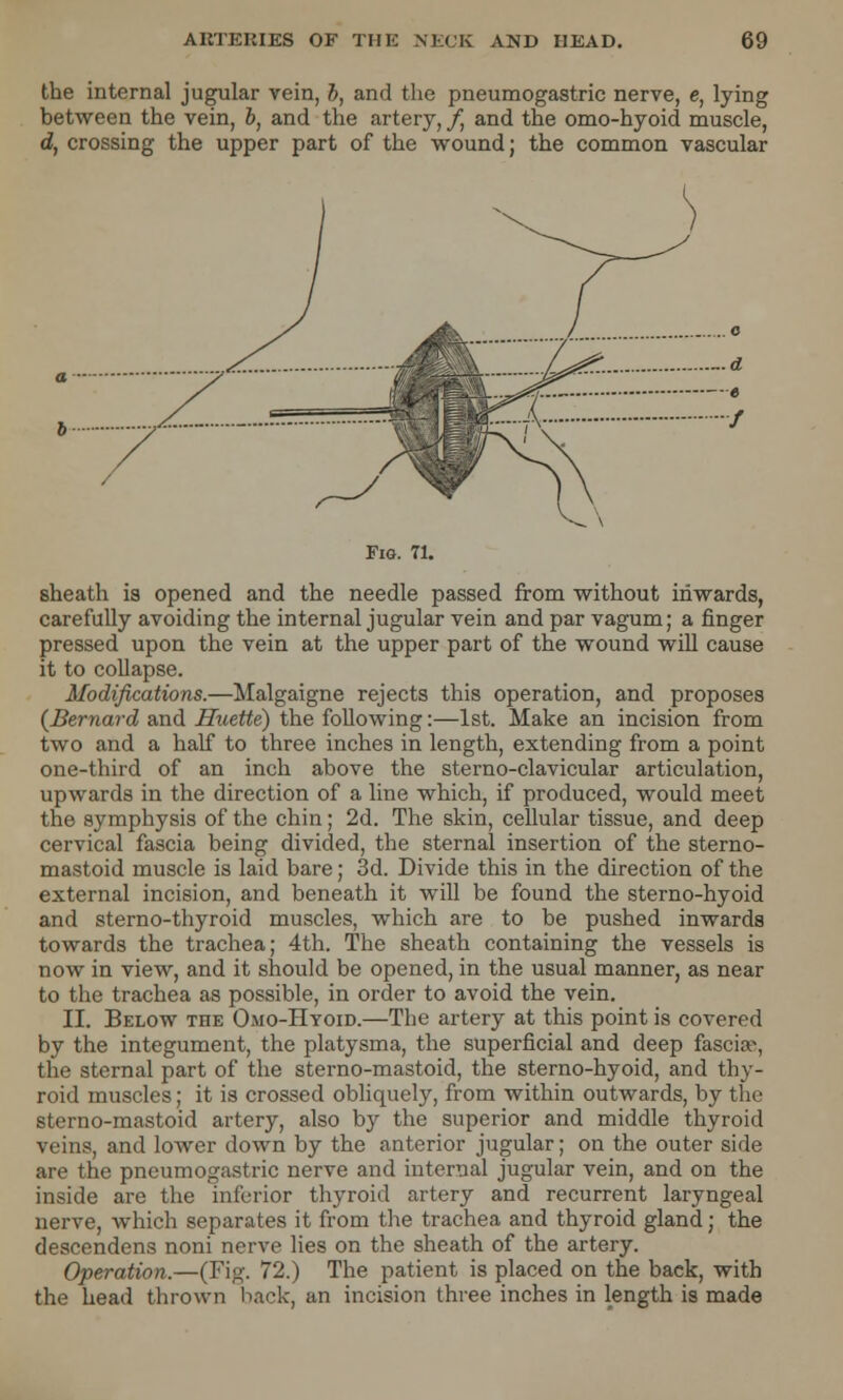 the internal jugular vein, b, and the pneumogastric nerve, c, lying between the vein, b, and the artery, /, and the omo-hyoid muscle, d, crossing the upper part of the wound; the common vascular Fig. 71. sheath is opened and the needle passed from without inwards, carefully avoiding the internal jugular vein and par vagum; a finger pressed upon the vein at the upper part of the wound will cause it to collapse. Modifications.—Malgaigne rejects this operation, and proposes (Bernard and Huette) the following:—1st. Make an incision from two and a half to three inches in length, extending from a point one-third of an inch above the sterno-clavicular articulation, upwards in the direction of a line which, if produced, would meet the symphysis of the chin; 2d. The skin, cellular tissue, and deep cervical fascia being divided, the sternal insertion of the sterno- mastoid muscle is laid bare; 3d. Divide this in the direction of the external incision, and beneath it will be found the sterno-hyoid and sterno-thyroid muscles, which are to be pushed inwards towards the trachea; 4th. The sheath containing the vessels is now in view, and it should be opened, in the usual manner, as near to the trachea as possible, in order to avoid the vein. II. Below the Omo-Hyoid.—The artery at this point is covered by the integument, the platysma, the superficial and deep fascia^, the sternal part of the sterno-mastoid, the sterno-hyoid, and thy- roid muscles; it is crossed obliquely, from within outwards, by the sterno-mastoid artery, also by the superior and middle thyroid veins, and lower down by the anterior jugular; on the outer side are the pneumogastric nerve and internal jugular vein, and on the inside are the inferior thyroid artery and recurrent laryngeal nerve, which separates it from the trachea and thyroid gland; the descendens noni nerve lies on the sheath of the artery. Operation.—(Fig. 72.) The patient is placed on the back, with the head thrown back, an incision three inches in length is made