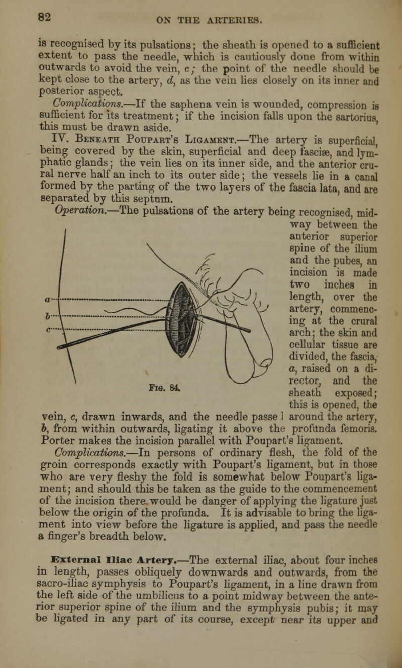 is recognised by its pulsations; the sheath is opened to a sufficient extent to pass the needle, which is cautiously done from within outwards to avoid the vein, c; the point of the needle should be kept close to the artery, d, as the vein lies closely on its inner and posterior aspect. Complications.—If the saphena vein is wounded, compression is sufficient for Its treatment; if the incision falls upon the sartoriua this must be drawn aside. IV. Beneath Poupart's Ligament.—The artery is superficial being covered by the skin, superficial and deep fasciae, and lym- phatic glands; the vein lies on its inner side, and the anterior cru- ral nerve half an inch to its outer side; the vessels he in a canal formed by the parting of the two layers of the fascia lata, and are separated by this septum. Operation.—The pulsations of the artery being recognised, mid- way between the I anterior superior / \ spine of the ilium / n. / and the pubes, an I ^^ // / n incision is made I ANfl?/y *wo inches in a...| Iw&b&J&^^U length, over the 1 ^_^—\_/T§ii8L&r 'hX V artery, commenc- h\ ^^PH^^A \ ing at the crural c V—^^*--- mm£l j |\ \ arch; the skin and ^^^^ \fir/ \ \ ceHular tissue are \ ^r / I \y-j divided, the fascia, \ \ Y~f a, raised on a di- \ __ «1 V^v^ rector, and the FM'81 sheath ei this is opened, the vein, c, drawn inwards, and the needle passe 1 around the artery, b, from within outwards, ligating it above the profunda femoris. Porter makes the incision parallel with Poupart's ligament. Complications.—In persons of ordinary flesh, the fold of the groin corresponds exactly with Poupart's ligament, but in those who are very fleshy the fold is somewhat below Poupart's liga- ment; and should this be taken as the guide to the commencement of the incision there, would be danger of applying the ligature just below the origin of the profunda. It is advisable to bring the liga- ment into view before the ligature is applied, and pass the needle a finger's breadth below. External Iliac Artery.—The external iliac, about four inches in length, passes obliquely downwards and outwards, from the sacro-iliac symphysis to Poupart's ligament, in a line drawn from the left side of the umbilicus to a point midway between the ante- rior superior spine of the ilium and the symphysis pubis; it may be ligated in any part of its course, except near its upper and