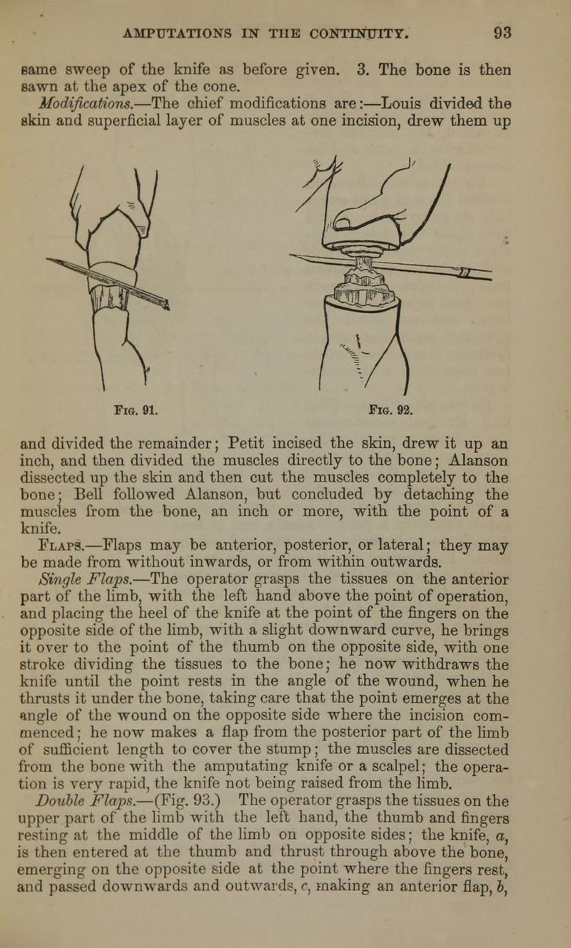 Bame sweep of the knife as before given. 3. The bone is then sawn at the apex of the cone. Modifications.—The chief modifications are:—Louis divided the skin and superficial layer of muscles at one incision, drew them up Fig. 91. Fig. 92. and divided the remainder; Petit incised the skin, drew it up an inch, and then divided the muscles directly to the bone; Alanson dissected up the skin and then cut the muscles completely to the bone; Bell followed Alanson, but concluded by detaching the muscles from the bone, an inch or more, with the point of a knife. Flaps.—Flaps may be anterior, posterior, or lateral; they may be made from without inwards, or from within outwards. Single Flaps.—The operator grasps the tissues on the anterior part of the limb, with the left hand above the point of operation, and placing the heel of the knife at the point of the fingers on the opposite side of the limb, with a slight downward curve, he brings it over to the point of the thumb on the opposite side, with one stroke dividing the tissues to the bone; he now withdraws the knife until the point rests in the angle of the wound, when he thrusts it under the bone, taking care that the point emerges at the angle of the wound on the opposite side where the incision com- menced ; he now makes a flap from the posterior part of the limb of sufficient length to cover the stump; the muscles are dissected from the bone with the amputating knife or a scalpel; the opera- tion is very rapid, the knife not being raised from the limb. Double Flaps.—(Fig. 93.) The operator grasps the tissues on the upper part of the limb with the left hand, the thumb and fingers resting at the middle of the limb on opposite sides; the knife, a, is then entered at the thumb and thrust through above the bone, emerging on the opposite side at the point where the fingers rest, and passed downwards and outwards, c, making an anterior flap, b,