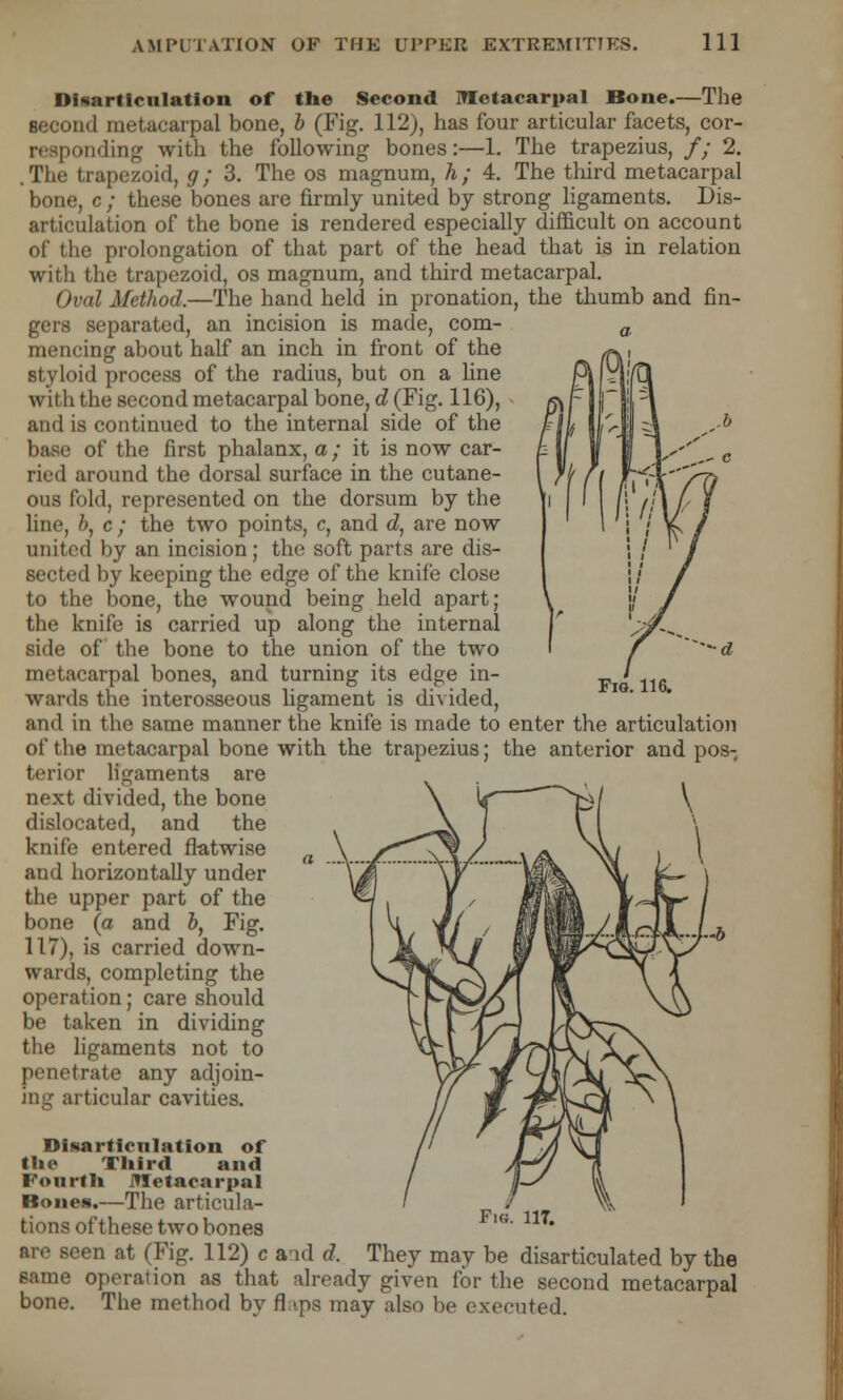 Fig. 116. Disarticulation of the Second metacarpal Bone.—The second metacarpal bone, b (Fig. 112), has four articular facets, cor- ponding with the following bones:—1. The trapezius, // 2. . The trapezoid, g; 3. The os magnum, h; 4. The third metacarpal bone, c ; these bones are firmly united by strong ligaments. Dis- articulation of the bone is rendered especially difficult on account of the prolongation of that part of the head that is in relation with the trapezoid, os magnum, and third metacarpal. Oval Method.—The hand held in pronation, the thumb and fin- gers separated, an incision is made, com- mencing about half an inch in front of the styloid process of the radius, but on a line with the second metacarpal bone, d (Fig. 116), and is continued to the internal side of the base of the first phalanx, a; it is now car- ried around the dorsal surface in the cutane- ous fold, represented on the dorsum by the line, b, c ; the two points, c, and d, are now united by an incision; the soft parts are dis- sected by keeping the edge of the knife close to the bone, the wound being held apart; the knife is carried up along the internal side of the bone to the union of the two metacarpal bones, and turning its edge in- wards the interosseous ligament is divided, and in the same manner the knife is made to enter the articulation of the metacarpal bone with the trapezius; the anterior and pos- terior ligaments are next divided, the bone \ U ' V)/ \ dislocated, and the knife entered flatwise and horizontally under the upper part of the bone (a and b, Fig. 117), is carried down- wards, completing the operation; care should be taken in dividing the ligaments not to penetrate any adjoin- ing articular cavities. Disarticulation of the Third and Fourth Metacarpal Bones.—The articula- tions of these two bones are seen at (Fig. 112) c and d. They may be disarticulated by the same operation as that already given for the second metacarpal bone. The method by fl >ps may also be executed.