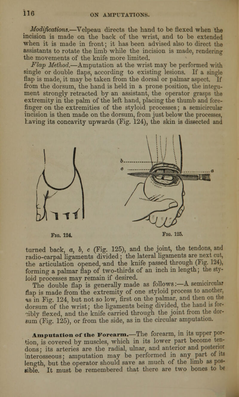 Modifications.—Velpeau directs the hand to be flexed when the incision is made on the back of the wrist, and to be extended when it is made in front; it has been advised also to direct the assistants to rotate the limb while the incision is made, rendering the movements of the knife more limited. Flap Method.—Amputation at the wrist may be performed with single or double flaps, according to existing lesions. If a single flap is made, it may be taken from the dorsal or palmar aspect. If from the dorsum, the hand is held in a prone position, the integu- ment strongly retracted by an assistant, the operator grasps the extremity in the palm of the left hand, placing the thumb and fore- finger on the extremities of the styloid processes; a semicircular incision is then made on the dorsum, from just below the processes, having its concavity upwards (Fig. 124), the skin is dissected and Fig. 124 Fig. 125. turned back, a, b, c (Fig. 125), and the joint, the tendons, and radio-carpal ligaments divided; the lateral ligaments are next cut, the articulation opened, -and the knife passed through (Fig. 124), forming a palmar flap of two-thirds of an inch in length; the sty- loid processes may remain if desired. The double flap is generally made as follows:—A semicircular flap is made from the extremity of one styloid process to another, as in Fig. 124, but not so low, first on the palmar, and then on the dorsum of the wrist; the ligaments being divided, the hand is for- cibly flexed, and the knife carried through the joint from the dor- sum (Fig. 125), or from the side, as in the circular amputation. Amputation of the Forearm.—The forearm, in its upper por- tion, is covered by muscles, which in its lower part become ten- dons ; its arteries are the radial, ulnar, and anterior and posterior interosseous; amputation may be performed in any part of ita length, but the operator should save as much of the limb as pos- sible. It must be remembered that there are two bones to be