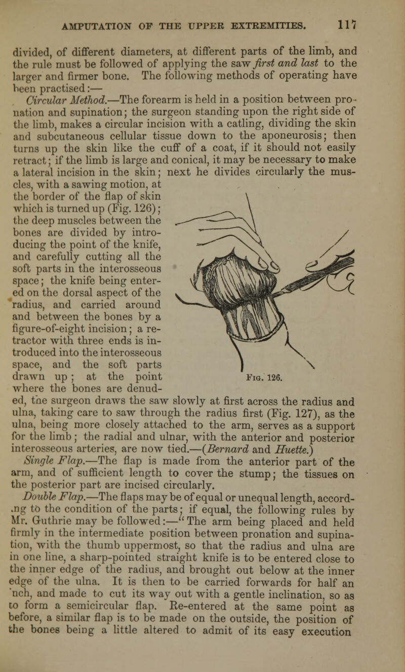 divided, of different diameters, at different parts of the limb, and the rule must be followed of applying the saw first and last to the larger and firmer bone. The following methods of operating have been practised:— Circular Method.—The forearm is held in a position between pro- nation and supination; the surgeon standing upon the right side of the limb, makes a circular incision with a catling, dividing the skin and subcutaneous cellular tissue down to the aponeurosis; then turns up the skin like the cuff of a coat, if it should not easily retract; if the limb is large and conical, it may be necessary to make a lateral incision in the skin; next he divides circularly the mus- cles, with a sawing motion, at the border of the flap of skin which is turned up (Fig. 126) ; the deep muscles between the bones are divided by intro- ducing the point of the knife, and carefully cutting all the soft parts in the interosseous space; the knife being enter- ed on the dorsal aspect of the radius, and carried around and between the bones by a figure-of-eight incision; a re- tractor with three ends is in- troduced into the interosseous space, and the soft parts where the bones are denud- ed, the surgeon draws the saw slowly at first across the radius and ulna, taking care to saw through the radius first (Fig. 127), as the ulna, being more closely attached to the arm, serves as a support for the limb; the radial and ulnar, with the anterior and posterior interosseous arteries, are now tied.—{Bernard and Huette.) Single Flap.—The flap is made from the anterior part of the arm, and of sufficient length to cover the stump; the tissues on the posterior part are incised circularly. Double Flap.—The flaps maybe of equal or unequal length, accord- •ng to the condition of the parts; if equal, the following rules by Mr. Guthrie may be followed:— The arm being placed and held firmly in the intermediate position between pronation and supina- tion, with the thumb uppermost, so that the radius and ulna are in one line, a sharp-pointed straight knife is to be entered close to the inner edge of the radius, and brought out below at the inner edge of the ulna. It is then to be carried forwards for half an nch, and made to cut its way out with a gentle inclination, so as to form a semicircular flap. Re-entered at the same point as before, a similar flap is to be made on the outside, the position of the bones being a little altered to admit of its easy execution