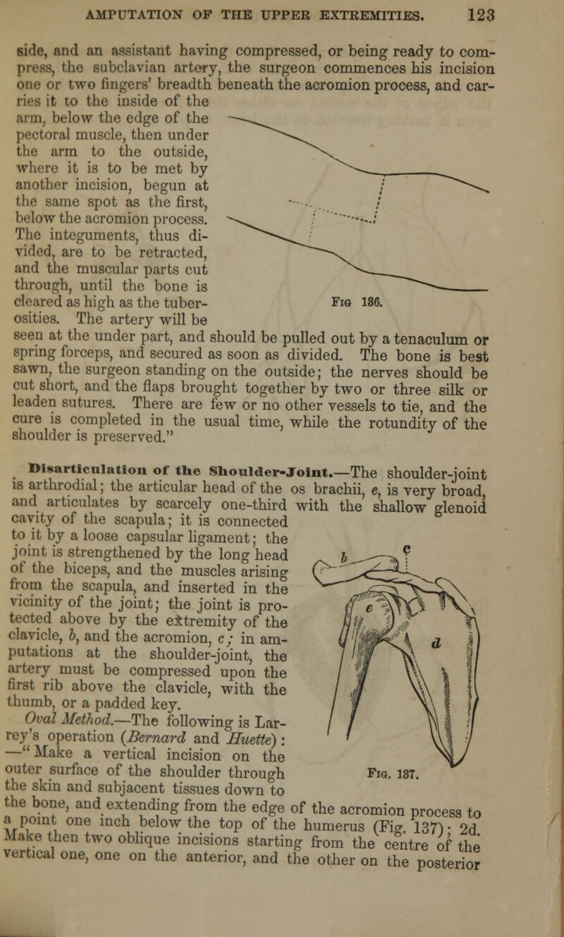 side, and an assistant having compressed, or being ready to com- press, the subclavian artery, the surgeon commences his incision one or two fingers' breadth beneath the acromion process, and car- ries it to the inside of the arm, below the edge of the pectoral muscle, then under the arm to the outside, where it is to be met by another incision, begun at the same spot as the first, below the acromion process. The integuments, thus di- vided, are to be retracted, and the muscular parts cut through, until the bone is cleared as high as the tuber- Fig 186. osities. The artery will be seen at the under part, and should be pulled out by a tenaculum or spring forceps, and secured as soon as divided. The bone is best sawn, the surgeon standing on the outside; the nerves should be cut short, and the flaps brought together by two or three silk or leaden sutures. There are few or no other vessels to tie, and the cure is completed in the usual time, while the rotundity of the shoulder is preserved. Disarticulation of tlie Shoulder-Joint.—The shoulder-joint is arthrodial; the articular head of the os brachii, e, is very broad and articulates by scarcely one-third with the shallow glenoid cavity of the scapula; it is connected to it by a loose capsular ligament; the joint is strengthened by the long head of the biceps, and the muscles arising from the scapula, and inserted in the vicinity of the joint; the joint is pro- tected above by the eitremity of the clavicle, b, and the acromion, c; in am- putations at the shoulder-joint, the artery must be compressed upon the first rib above the clavicle, with the thumb, or a padded key. Oval Method.—The following is Lar- rey's operation (Bernard and Huette) : —Make a vertical incision on the outer surface of the shoulder through the skin and subjacent tissues down to the bone, and extending from the edge of the acromion process to a point one inch below the top of the humerus (Fig 137V 2d Make then two oblique incisions starting from the centre of the vertical one, one on the anterior, and the other on the posterior Fig. 18T.