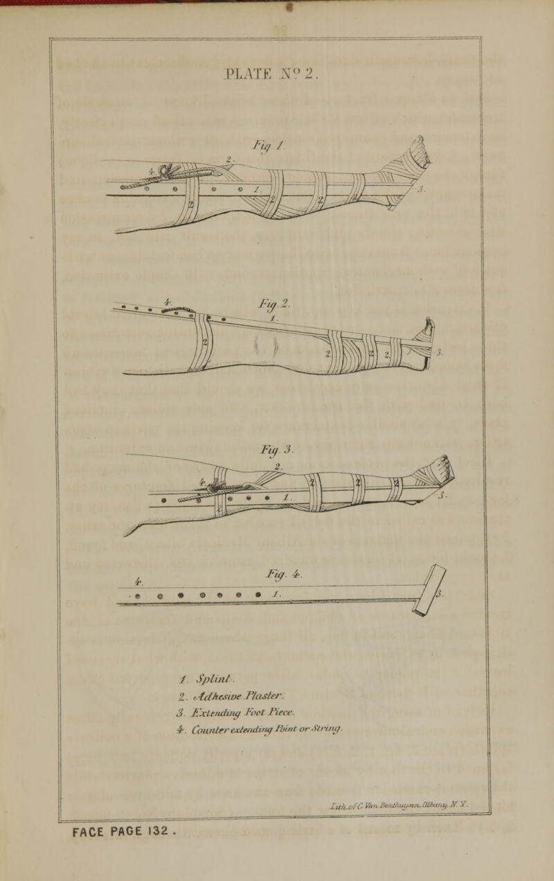 !>L\TK S?2 l-u, 3 i-u/ ;• / Splint 2. i IdJusive Tlaster. 3. Extending Foot Piece. i Counter'extending t'omt orStruy. C Van. BerUkui+xn. GJki ■ FACE PAGE 132