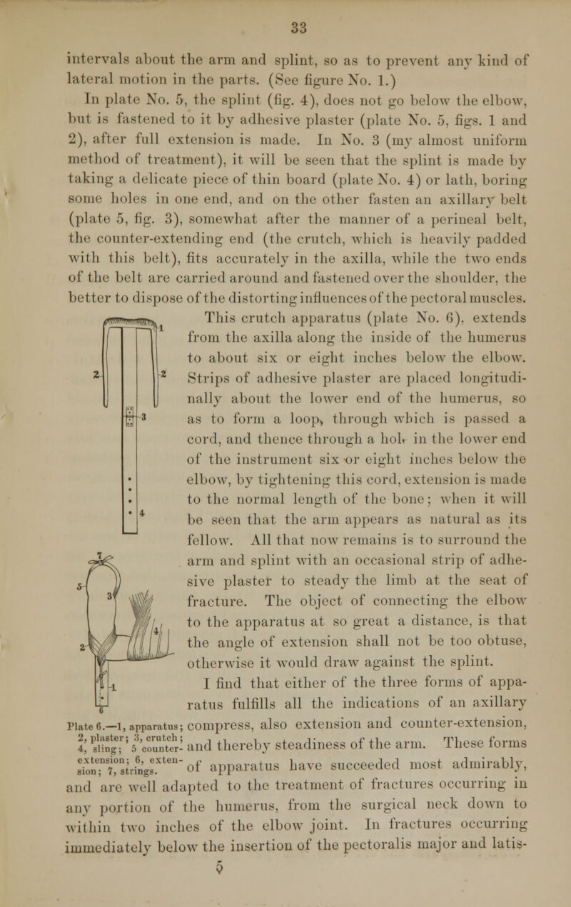 («•■% I-: intervals about the arm and splint, so as to prevent any kind of lateral motion in the parts. (See figure No. 1.) In plate No. 5, the splint (fig. 4), does not go below the elbow, but is fastened to it by adhesive plaster (plate No. 5, figs. 1 and 2), after full extension is made. In No. 3 (my almost uniform method of treatment), it will be seen that the splint is made by taking a delicate piece of thin board (plate Xo. 4) or lath, boring some holes in one end, and on the other fasten an axillary belt (plate 5, fig. 3), somewhat after the manner of a perineal belt, the counter-extending end (the crutch, which is heavily padded with this belt), fits accurately in the axilla, while the two ends of the belt are carried around and fastened over the shoulder, the better to dispose of the distorting influences of the pectoral muscles. This crutch apparatus (plate Xo. '!). extends from the axilla along the inside of the humerus to about six or eight inches below the elbow. Strips of adhesive plaster are placed longitudi- nally about the lower end of the humerus, so as to form a loop, through which is passed a cord, and thence through a hoi. in the lower end of the instrument six or eight inches below the elbow, by tightening this cord, extension is made to the normal length of the hone: when it will be seen that the arm appears as natural as its fellow. All that now remains is to surround the arm and splint with an occasional strip of adhe- sive plaster to steady the limb at the seat of fracture. The object of connecting the elbow to the apparatus at so great a distance, is that the angle of extension shall not be too obtuse, otherwise it would draw against the splint. I find that either of the three forms of appa- ratus fulfills all the indications of an axillary Pinte6.—i, apparatus; compress, also extension and counter-extension, I ffi£,; ftSft! and thereby steadiness of the arm. These forms siolTtstringsf1611 of apparatus have succeeded most admirably, and are well adapted to the treatment of fractures occurring in any portion of the humerus, from the surgical neck down to within two inches of the elbow joint. In fractures occurring immediately below the insertion of the pectoralis major and latis- 0