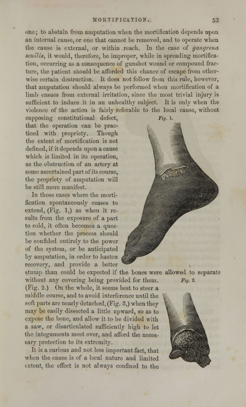 one; to abstain from amputation when the mortification depends upon an internal cause, or one that cannot be removed, and to operate when the cause is external, or within reach. In the case of gangretia senilis, it would, therefore, be improper, while in spreading mortifica- tion, occurring as a consequence of gunshot wound or compound frac- ture, the patient should be afforded this chance of escape from other- wise certain destruction. It does not follow from this rule, however, that amputation should always be performed when mortification of a limb ensues from external irritation, since the most trivial injury is sufficient to induce it in an unhealthy subject. It is only when the violence of the action is fairly referable to the local cause, without supposing constitutional defect, Fig. 1. that the operation can be prac- ticed with propriety. Though the extent of mortification is not defined, if it depends upon a cause which is limited in its operation, as the obstruction of an artery at some ascertained part of its course, the propriety of amputation will be still more manifest. In those cases where the morti- fication spontaneously ceases to extend, (Fig. 1,) as when it re- sults from the exposure of a part to cold, it often becomes a ques- tion whether the process should be confided entirely to the power of the system, or be anticipated by amputation, in order to hasten recovery, and provide a better stump than could be expected if the bones were allowed to separate without any covering being provided for them. (Fig. 2.) On the whole, it seems best to steer a middle course, and to avoid interference until the soft parts are nearly detached, (Fig. 3,) when they may be easily dissected a little upward, so as to expose the bone, and allow it to be divided with a saw, or disarticulated sufficiently high to let the integuments meet over, and afford the neces- sary protection to its extremity. It is a curious and not less important fact, that when the cause is of a local nature and limited extent, the effect is not always confined to the Fig. 2.