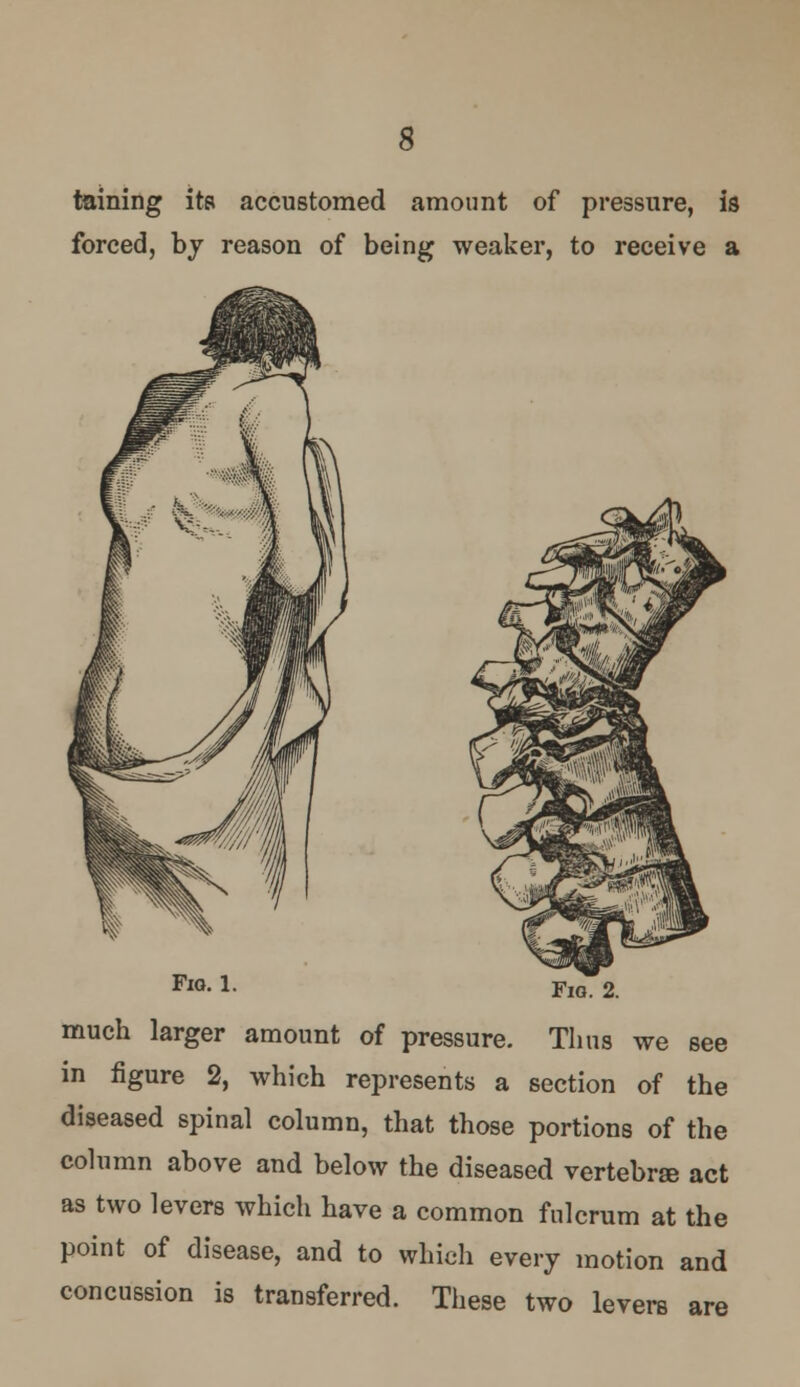 taining its accustomed amount of pressure, is forced, by reason of being weaker, to receive a FlG. l. Fig. 2. much larger amount of pressure. Thus we see in figure 2, which represents a section of the diseased spinal column, that those portions of the column above and below the diseased vertebrae act as two levers which have a common fulcrum at the point of disease, and to which every motion and concussion is transferred. These two levers are