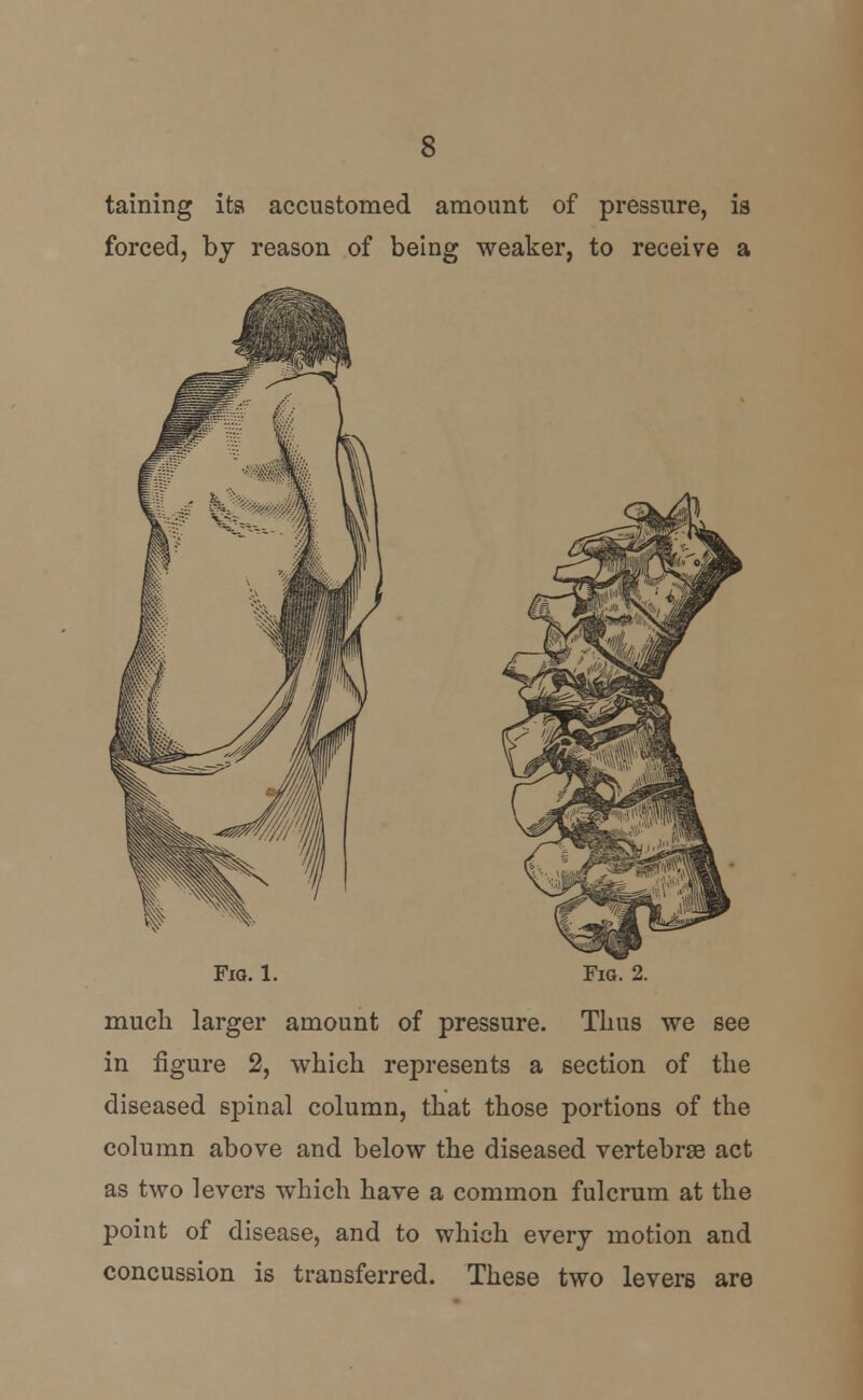 taming its accustomed amount of pressure, is forced, by reason of being weaker, to receive a Fm. l. Fig. 2. much larger amount of pressure. Thus we see in figure 2, which represents a section of the diseased spinal column, that those portions of the column above and below the diseased vertebrse act as two levers which have a common fulcrum at the point of disease, and to which every motion and concussion is transferred. These two levers are