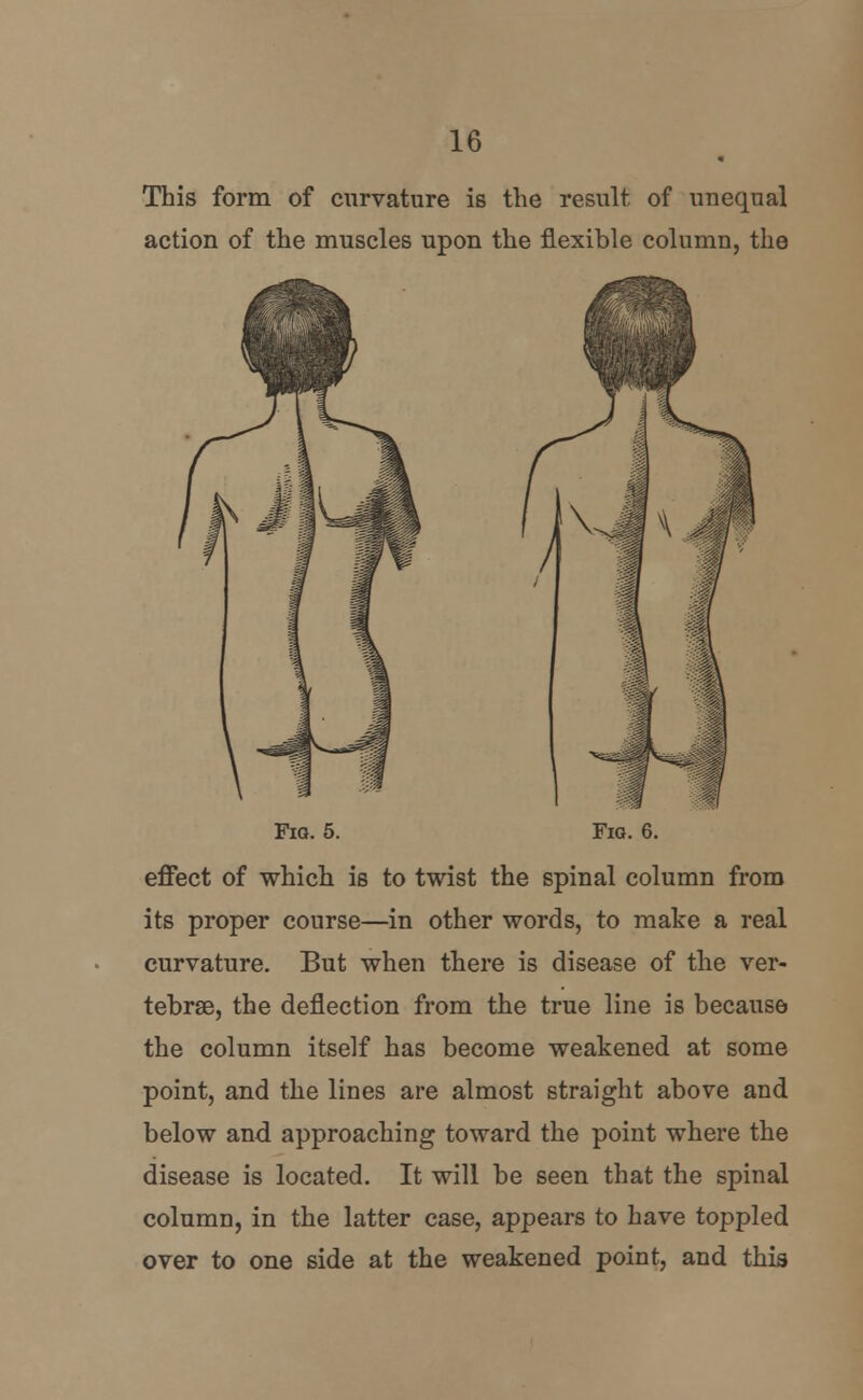 This form of curvature is the result of unequal action of the muscles upon the flexible column, the Fig. 5. Fig. 6. effect of which is to twist the spinal column from its proper course—in other words, to make a real curvature. But when there is disease of the ver- tebrae, the deflection from the true line is because the column itself has become weakened at some point, and the lines are almost straight above and below and approaching toward the point where the disease is located. It will be seen that the spinal column, in the latter case, appears to have toppled over to one side at the weakened point, and this