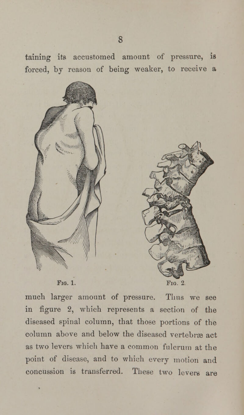 s taining its accustomed amount of pressure, is forced, by reason of being weaker, to receive a Fig. 1. Fig. 2. much larger amount of pressure. Thus we see in figure 2, which represents a section of the diseased spinal column, that those portions of the column above and below the diseased vertebrae act as two levers which have a common fulcrum at the point of disease, and to which every motion and concussion is transferred. These two levers are