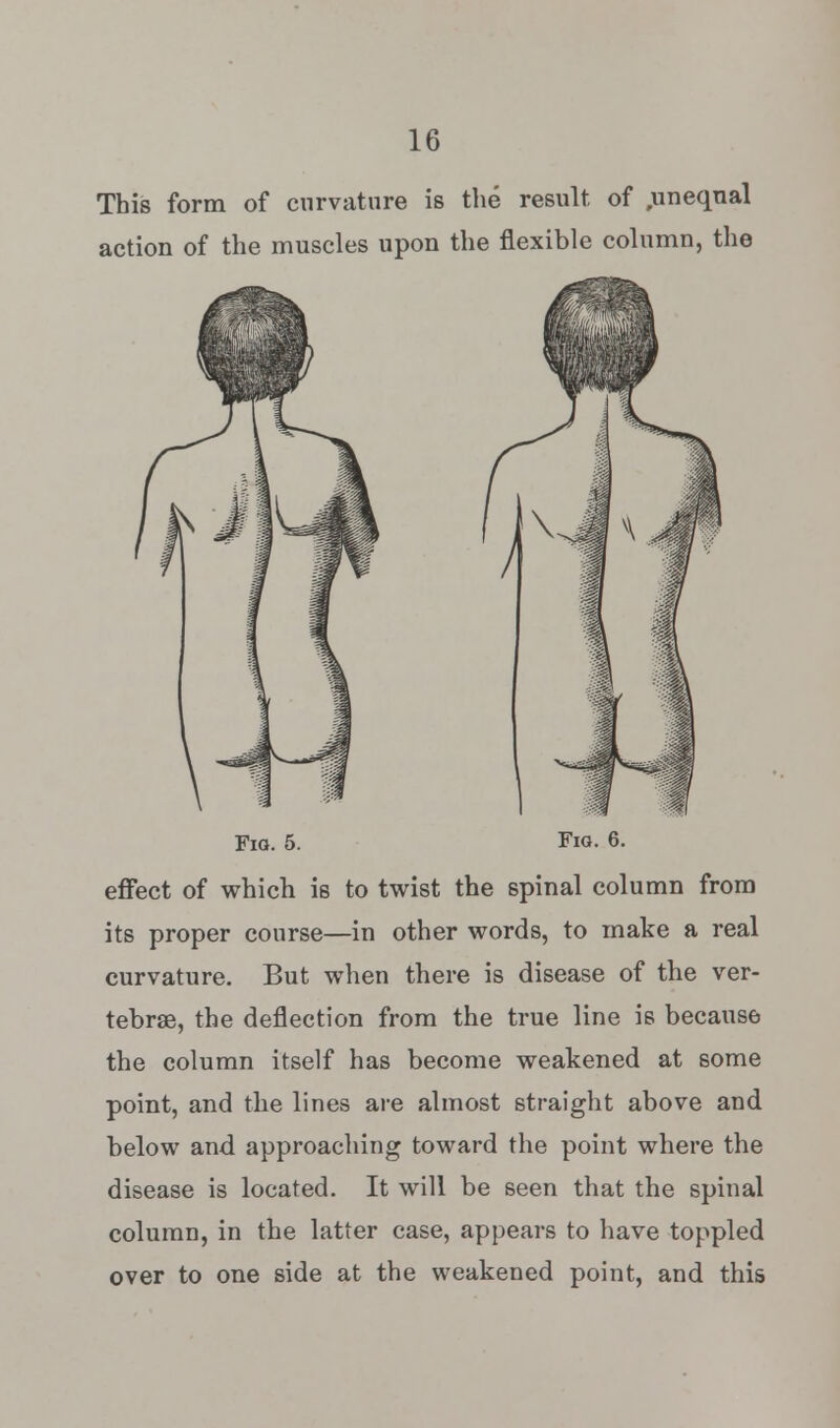 This form of curvature is the result of ,unequal action of the muscles upon the flexible column, the Fig. 5. Fig. 6. effect of which is to twist the spinal column from its proper course—in other words, to make a real curvature. But when there is disease of the ver- tebrae, the deflection from the true line is because the column itself has become weakened at some point, and the lines are almost straight above and below and approaching toward the point where the disease is located. It will be seen that the spinal column, in the latter case, appears to have toppled over to one side at the weakened point, and this