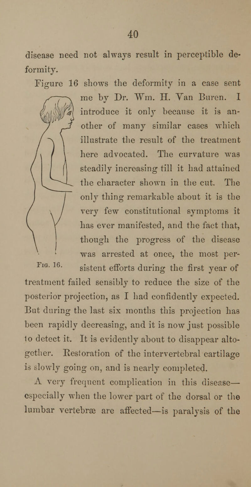 disease need not always result in perceptible de- formity. Figure 16 shows the deformity in a case sent me by Dr. Wm. H. Yan Buren. I %} introduce it only because it is an- other of many similar cases which illustrate the result of the treatment here advocated. The curvature was steadily increasing till it had attained the character shown in the cut. The only thing remarkable about it is the very few constitutional symptoms it has ever manifested, and the fact that, though the progress of the disease was arrested at once, the most per- sistent efforts during the first year of treatment failed sensibly to reduce the size of the posterior projection, as I had confidently expected. But during the last six months this projection has been rapidly decreasing, and it is now just possible 1o detect it. It is evidently about to disappear alto- gether. Restoration of the intervertebral cartilage is slowly going on, and is nearly completed. A very frequent complication in this disease— especially when the lower part of the dorsal or the lumbar vertebra are affected—is paralysis of the Fig. 16.