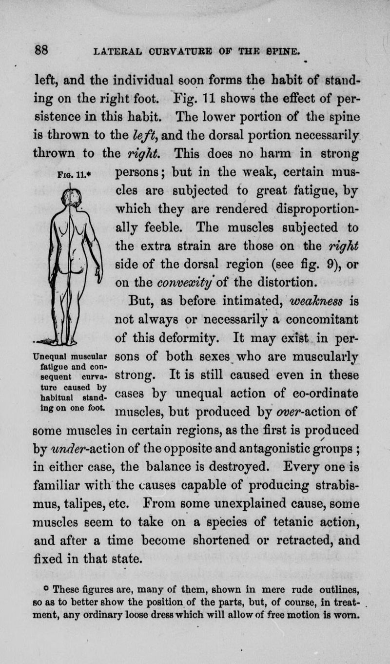 left, and the individual soon forms the habit of stand- ing on the right foot. Fig. 11 shows the effect of per- sistence in this habit. The lower portion of the spine is thrown to the left, and the dorsal portion necessarily thrown to the right. This does no harm in strong Fxo.ii.* persons; but in the weak, certain mus- cles are subjected to great fatigue, by which they are rendered disproportion- ally feeble. The muscles subjected to the extra strain are those on the right side of the dorsal region (see fig. 9), or on the convexity of the distortion. But, as before intimated, weakness is not always or necessarily a concomitant of this deformity. It may exist in per- unequai muscular sons of both sexes who are muscularly fatigue and con- . . . sequent curva- strong. It is still caused even in these ture caused by -, i ,. « j« . habitual stand- cases by unequal action ot co-ordinate ing on one foot. musc]eS) k^ produced by over-2iCt\<m of some muscles in certain regions, as the first is produced by under-o.ctxon of the opposite and antagonistic groups ; in either case, the balance is destroyed. Every one is familiar with the causes capable of producing strabis- mus, talipes, etc. From some unexplained cause, some muscles seem to take on a species of tetanic action, and after a time become shortened or retracted, and fixed in that state. 6 These figures are, many of them, shown in mere rude outlines, so as to better show the position of the parts, but, of course, in treat- ment, any ordinary loose dress which will allow of free motion is worn.