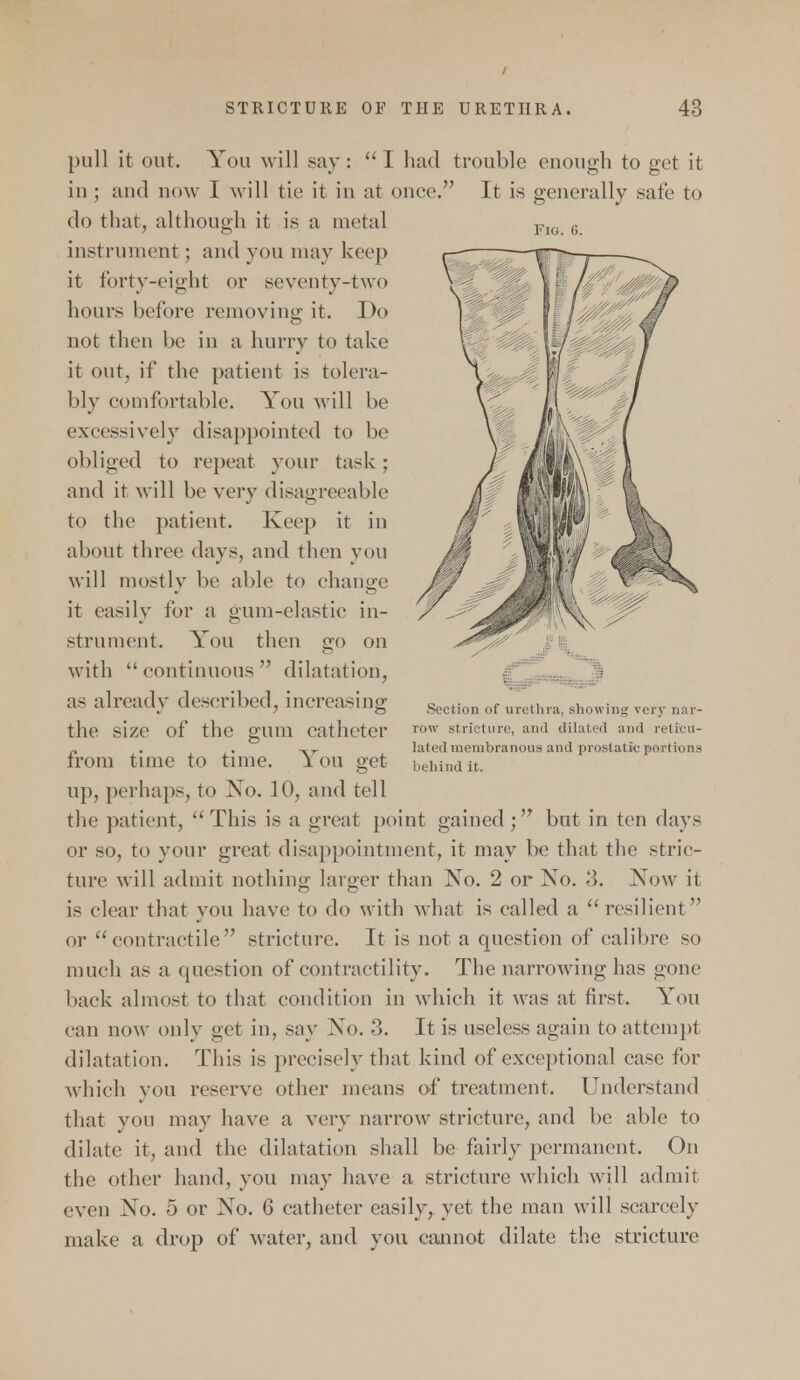 / STRICTURE OF THE URETHRA. 43 pull it out. You will say: I had trouble enough to get it in ; and now I will tie it in at once. It is generally safe to do that, although it is a metal instrument; and you may keep it forty-eight or seventy-two hours before removing it. Do not then be in a hurry to take it out, if the patient is tolera- bly comfortable. You will be excessively disappointed to be obliged to repeat your task ; and it will be very disagreeable to the patient. Keep it in about three days, and then yon will mostly be able to change it easily for a gum-elastic in- strument. You then go on with continuous dilatation, as already described, increasing Soction of urethra showing verv nar_ the size of the glUU catheter row stricture, and dilated and retiteu- » . . Isted membranous and prostatic portions irom time to time. 1 on get behind it. up, perhaps, to Xo. 10, and tell the patient, This is a great point gained; but in ten days or so, to your great disappointment, it may be that the stric- ture will admit nothing larger than Xo. 2 or No. 3. Now it is clear that you have to do with what is called a resilient or contractile stricture. It is not a question of calibre so much as a question of contractility. The narrowing lias gone back almost to that condition in which it was at first. You can now only get in, say No. 3. It is useless again to attempt dilatation. This is precisely that kind of exceptional case for which you reserve other means of treatment. Understand that you may have a very narrow stricture, and be able to dilate it, and the dilatation shall be fairly permanent. On the other hand, you may have a stricture which will admit even No. 5 or No. 6 catheter easily, yet the man will scarcely make a drop of water, and you cannot dilate the stricture