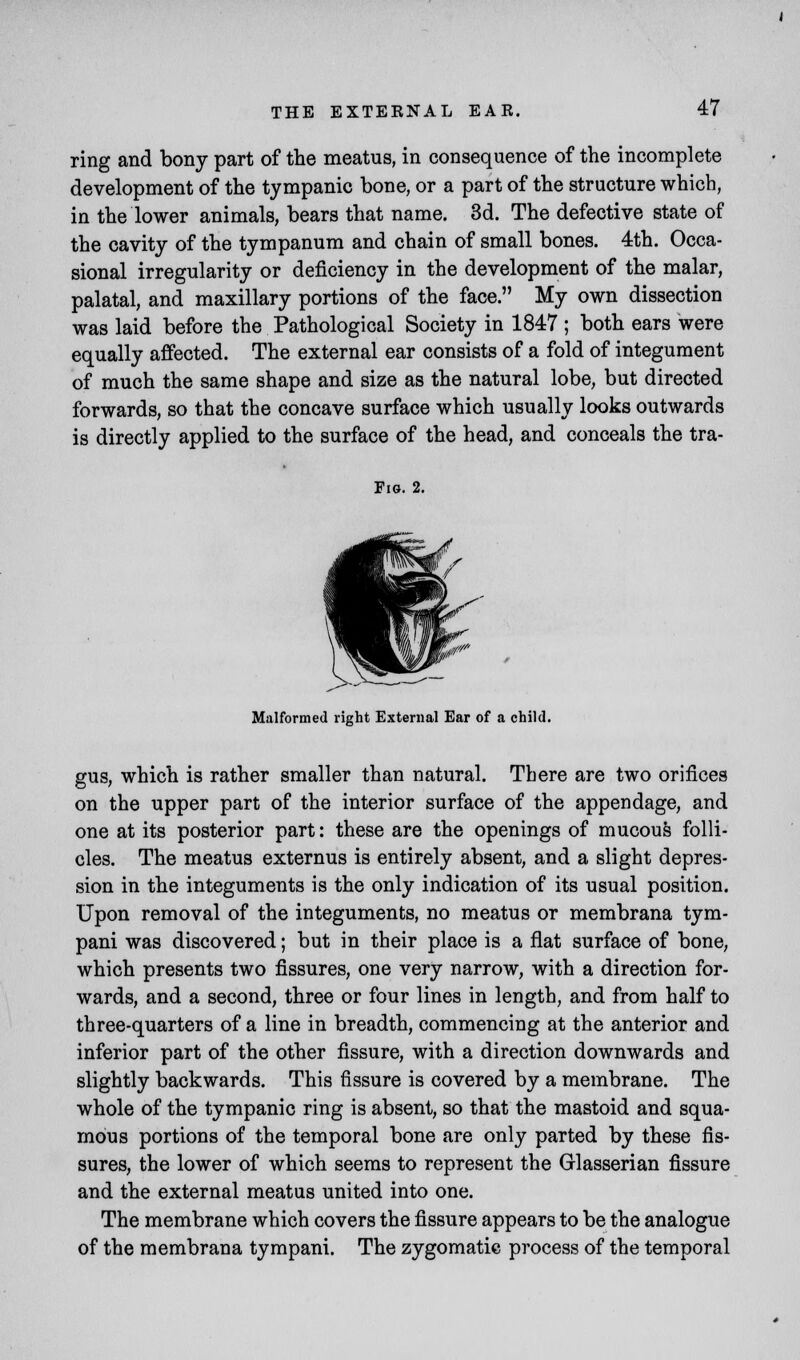 ring and bony part of the meatus, in consequence of the incomplete development of the tympanic bone, or a part of the structure which, in the lower animals, bears that name. 3d. The defective state of the cavity of the tympanum and chain of small bones. 4th. Occa- sional irregularity or deficiency in the development of the malar, palatal, and maxillary portions of the face. My own dissection was laid before the Pathological Society in 1847 ; both ears were equally affected. The external ear consists of a fold of integument of much the same shape and size as the natural lobe, but directed forwards, so that the concave surface which usually looks outwards is directly applied to the surface of the head, and conceals the tra- Fig. 2. Malformed right External Ear of a child. gus, which is rather smaller than natural. There are two orifices on the upper part of the interior surface of the appendage, and one at its posterior part: these are the openings of mucous folli- cles. The meatus externus is entirely absent, and a slight depres- sion in the integuments is the only indication of its usual position. Upon removal of the integuments, no meatus or membrana tym- pani was discovered; but in their place is a flat surface of bone, which presents two fissures, one very narrow, with a direction for- wards, and a second, three or four lines in length, and from half to three-quarters of a line in breadth, commencing at the anterior and inferior part of the other fissure, with a direction downwards and slightly backwards. This fissure is covered by a membrane. The whole of the tympanic ring is absent, so that the mastoid and squa- mous portions of the temporal bone are only parted by these fis- sures, the lower of which seems to represent the Glasserian fissure and the external meatus united into one. The membrane which covers the fissure appears to be the analogue of the membrana tympani. The zygomatic process of the temporal