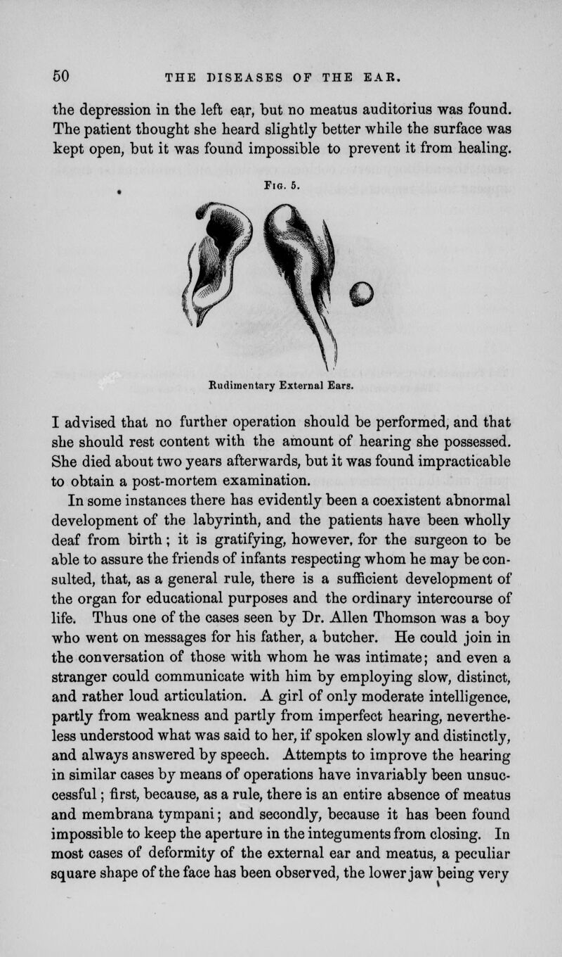 the depression in the left ear, but no meatus auditorius was found. The patient thought she heard slightly better while the surface was kept open, but it was found impossible to prevent it from healing. Fig. 5. Rudimentary External Ears. I advised that no further operation should be performed, and that she should rest content with the amount of hearing she possessed. She died about two years afterwards, but it was found impracticable to obtain a post-mortem examination. In some instances there has evidently been a coexistent abnormal development of the labyrinth, and the patients have been wholly deaf from birth; it is gratifying, however, for the surgeon to be able to assure the friends of infants respecting whom he may be con- sulted, that, as a general rule, there is a sufficient development of the organ for educational purposes and the ordinary intercourse of life. Thus one of the cases seen by Dr. Allen Thomson was a boy who went on messages for his father, a butcher. He could join in the conversation of those with whom he was intimate; and even a stranger could communicate with him by employing slow, distinct, and rather loud articulation. A girl of only moderate intelligence, partly from weakness and partly from imperfect hearing, neverthe- less understood what was said to her, if spoken slowly and distinctly, and always answered by speech. Attempts to improve the hearing in similar cases by means of operations have invariably been unsuc- cessful ; first, because, as a rule, there is an entire absence of meatus and membrana tympani; and secondly, because it has been found impossible to keep the aperture in the integuments from closing. In most cases of deformity of the external ear and meatus, a peculiar square shape of the face has been observed, the lower jaw being very