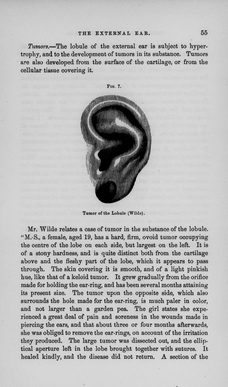 Tumors.—The lobule of the external ear is subject to hyper- trophy, and to the development of tumors in its substance. Tumors are also developed from the surface of the cartilage, or from the cellular tissue covering it. Fig. 7. Tumor of the Lobule (Wilde). Mr. Wilde relates a case of tumor in the substance of the lobule. M.S., a female, aged 19, has a hard, firm, ovoid tumor occupying the centre of the lobe on each side, but largest on the left. It is of a stony hardness, and is quite distinct both from the cartilage above and the fleshy part of the lobe, which it appears to pass through. The skin covering it is smooth, and of a light pinkish hue, like that of a keloid tumor. It grew gradually from the orifice made for holding the ear-ring, and has been several months attaining its present size. The tumor upon the opposite side, which also surrounds the hole made for the ear-ring, is much paler in color, and not larger than a garden pea. The girl states she expe- rienced a great deal of pain and soreness in the wounds made in piercing the ears, and that about three or four months afterwards, she was obliged to remove the ear-rings, on account of the irritation they produced. The large tumor was dissected out, and the ellip- tical aperture left in the lobe brought together with sutures. It healed kindly, and the disease did not return. A section of the