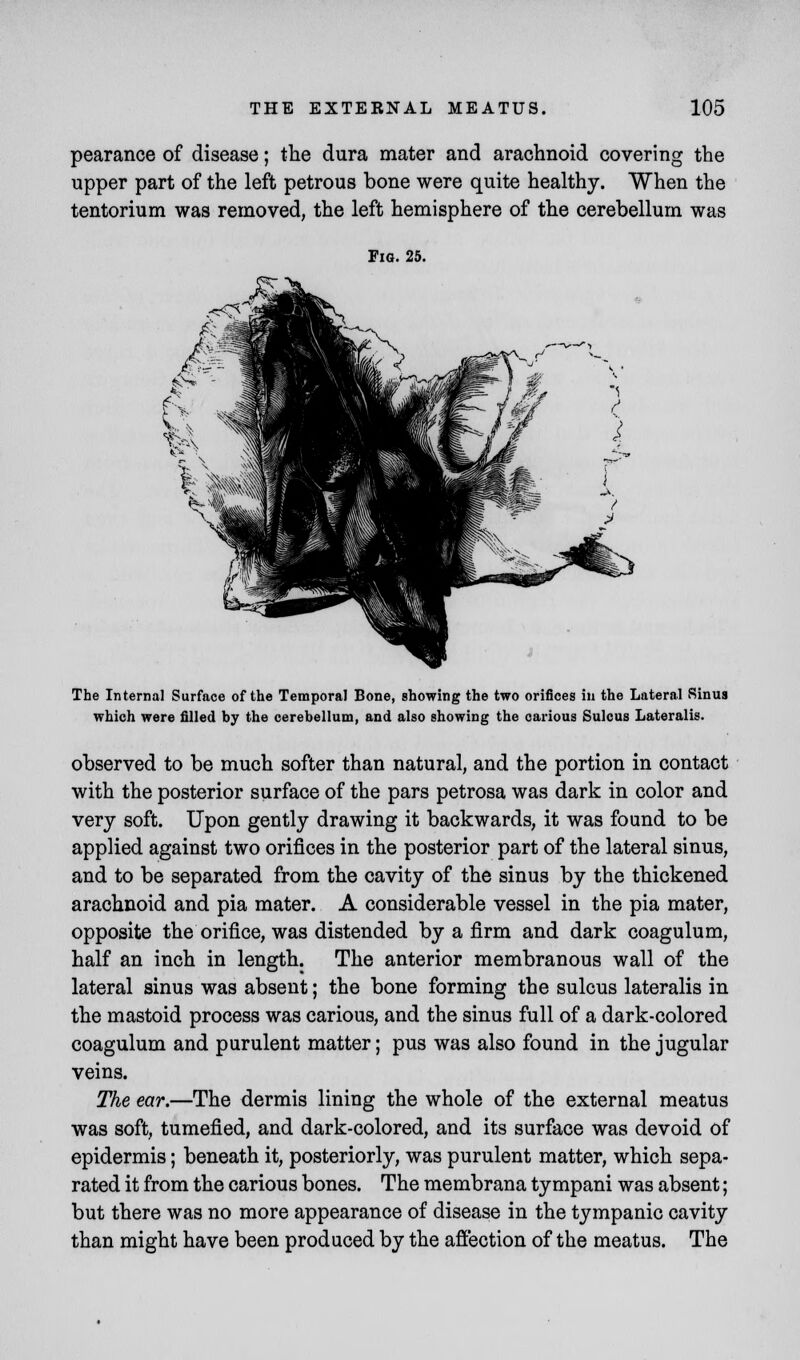 pearance of disease; the dura mater and arachnoid covering the upper part of the left petrous bone were quite healthy. When the tentorium was removed, the left hemisphere of the cerebellum was Fig. 25. The Internal Surface of the Temporal Bone, showing the two orifices in the Lateral Sinus which were filled by the cerebellum, and also showing the carious Sulcus Lateralis. observed to be much softer than natural, and the portion in contact with the posterior surface of the pars petrosa was dark in color and very soft. Upon gently drawing it backwards, it was found to be applied against two orifices in the posterior part of the lateral sinus, and to be separated from the cavity of the sinus by the thickened arachnoid and pia mater. A considerable vessel in the pia mater, opposite the orifice, was distended by a firm and dark coagulum, half an inch in length. The anterior membranous wall of the lateral sinus was absent; the bone forming the sulcus lateralis in the mastoid process was carious, and the sinus full of a dark-colored coagulum and purulent matter; pus was also found in the jugular veins. The ear.—The dermis lining the whole of the external meatus was soft, tumefied, and dark-colored, and its surface was devoid of epidermis; beneath it, posteriorly, was purulent matter, which sepa- rated it from the carious bones. The membrana ty mpani was absent; but there was no more appearance of disease in the tympanic cavity than might have been produced by the affection of the meatus. The