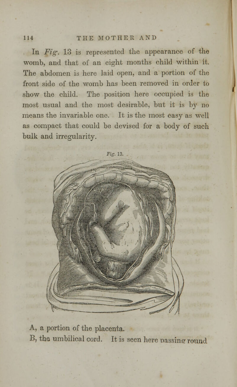 In Fig-. 13 is represented the appearance of the womb, and that of an eight months child within it. The abdomen is here laid open, and a portion of the front side of the womb has been removed in order to show the child. The position here occupied is the most usual and the most desirable, but it is by no means the invariable one. It is the most easy as well as compact that could be devised for a body of such bulk and irregularity. Fig. 13. A, a portion of the placenta. B, the umbilical cord. It is seen here nassintr round