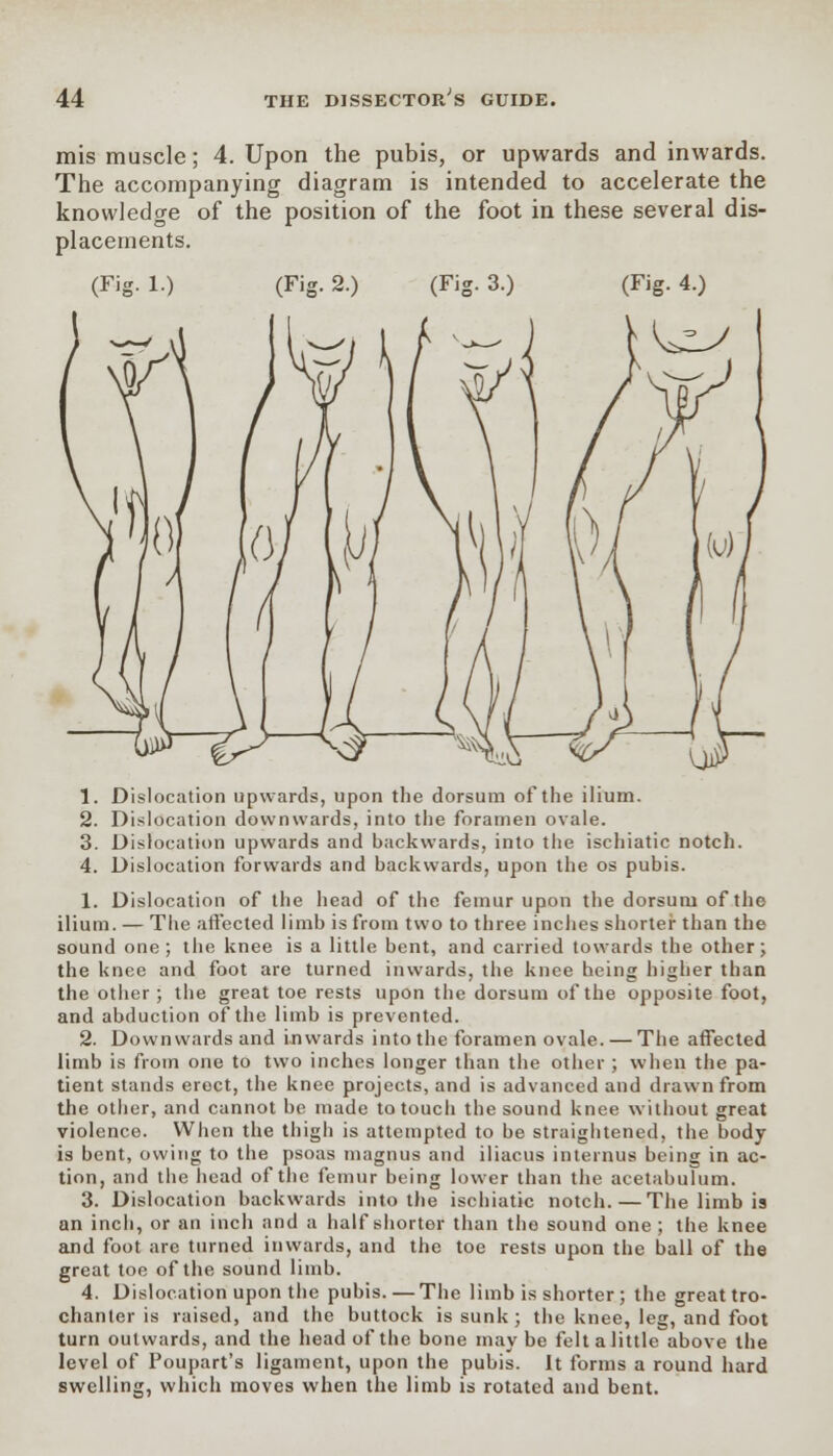 mis muscle; 4. Upon the pubis, or upwards and inwards. The accompanying diagram is intended to accelerate the knowledge of the position of the foot in these several dis- placements. (Fig. 4.) 1. Dislocation upwards, upon the dorsum of the ilium. 2. Dislocation downwards, into the foramen ovale. 3. Dislocation upwards and backwards, into the ischiatic notch. 4. Dislocation forwards and backwards, upon the os pubis. 1. Dislocation of the head of the femur upon the dorsum of the ilium. — The affected limb is from two to three inches shorter than the sound one; the knee is a little bent, and carried towards the other; the knee and foot are turned inwards, the knee heing higher than the other; the great toe rests upon the dorsum of the opposite foot, and abduction of the limb is prevented. 2. Downwards and inwards into the foramen ovale. — The affected limb is from one to two inches longer than the other ; when the pa- tient stands erect, the knee projects, and is advanced and drawn from the other, and cannot be made to touch the sound knee without great violence. When the thigh is attempted to be straightened, the body is bent, owing to the psoas magnus and iliacus internus being in ac- tion, and the head of the femur being lower than the acetabulum. 3. Dislocation backwards into the ischiatic notch.—The limb is an inch, or an inch and a half shorter than the sound one ; the knee and foot are turned inwards, and the toe rests upon the ball of the great toe of the sound limb. 4. Dislocation upon the pubis.—The limb is shorter; the great tro- chanter is raised, and the buttock is sunk ; the knee, leg, and foot turn outwards, and the head of the bone maybe felt a little above the level of Poupart's ligament, upon the pubis. It forms a round hard swelling, which moves when the limb is rotated and bent.