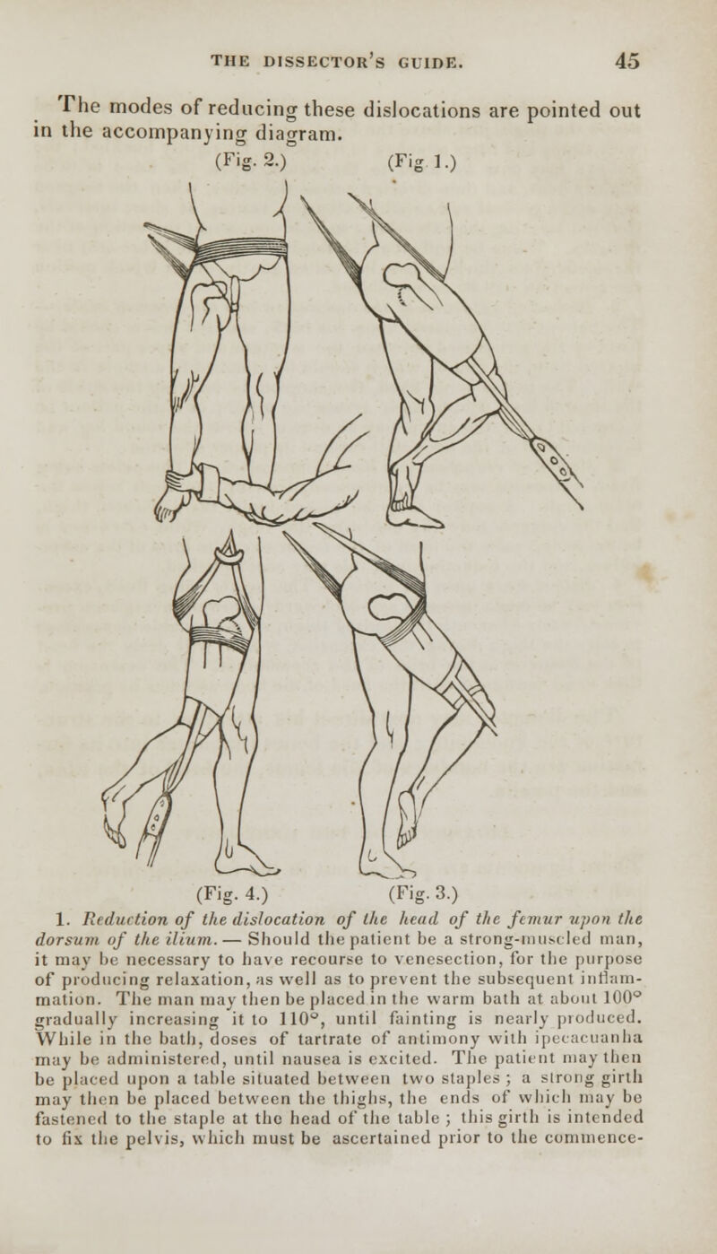 The modes of reducing these dislocations are pointed out in the accompanying diagram. (Fig. 2.)° (Fig 1.) (Fig. 4.) (Fig. 3.) 1. Reduction of the dislocation of the head of the femur upon the dorsum of the ilium.— Should the patient be a strong-muscled man, it may he necessary to have recourse to venesection, for the purpose of producing relaxation, as well as to prevent the subsequent inflam- mation. The man may then be placed in the warm bath at about 100° gradually increasing it to 110°, until fainting is nearly produced. While in the bath, doses of tartrate of antimony with ipecacuanha may be administered, until nausea is excited. The patient may then be placed upon a table situated between two staples ; a strong girth may the.n be placed between the thighs, the ends of which may be fastened to the staple at the head of the table ; this girth is intended to fix the pelvis, which must be ascertained prior to the commence-