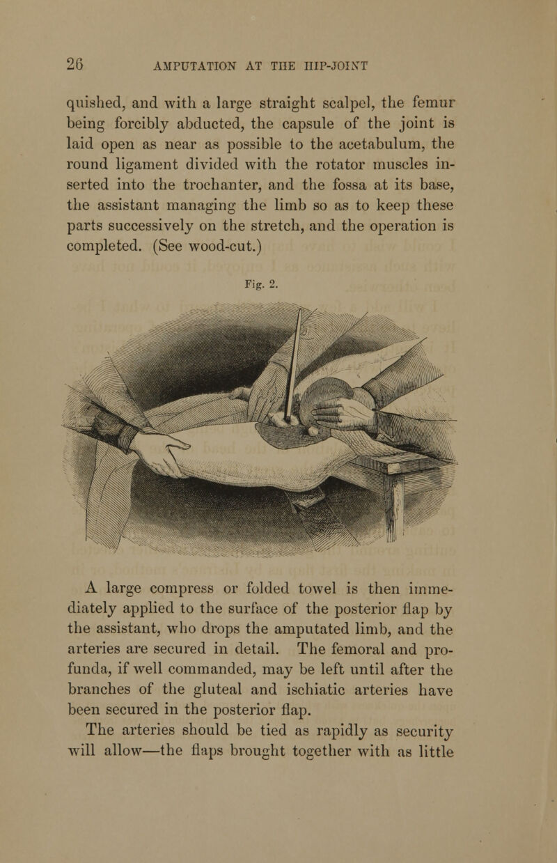 quished, and with a large straight scalpel, the femur being forcibly abducted, the capsule of the joint is laid open as near as possible to the acetabulum, the round ligament divided with the rotator muscles in- serted into the trochanter, and the fossa at its base, the assistant managing the limb so as to keep these parts successively on the stretch, and the operation is completed. (See wood-cut.) Fig. 2. A large compress or folded towel is then imme- diately applied to the surface of the posterior flap by the assistant, who drops the amputated limb, and the arteries are secured in detail. The femoral and pro- funda, if well commanded, may be left until after the branches of the gluteal and ischiatic arteries have been secured in the posterior flap. The arteries should be tied as rapidly as security will allow—the flaps brought together with as little