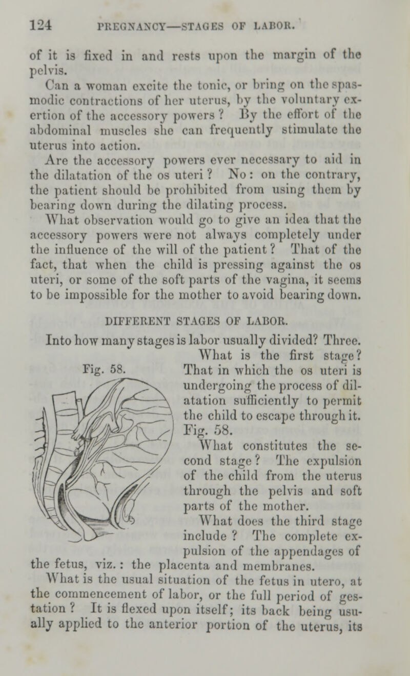 of it is fixed in and rests upon the margin of the pelvis. Can a woman excite the tonic, or bring on the.-: modic contractions of her uterus, by the voluntary ex- ertion of the accessory powers? By the effort of the abdominal muscles Bhe can frequently stimulate the uterus into action. Are the accessory powers ever necessary to aid in the dilatation of the os uteri? No: on the contrary, the patient should be prohibited from using them by bearing down during the dilating process. What observation would go to give an idea that the accessory powers were not always completely under the influence of the will of the patient? That of the fact, that when the child is pressing against the os uteri, or some of the soft parts of the vagina, it seemi to he impossible for the mother to avoid bearing down. DIFFERENT STAGES OF LABOR. Into how many stages is labor usually divided? Three. What is the first sti That in which the os uteri is undergoing the process of dil- atation sufficiently to permit the child to escape through it. Fig. 58. What constitutes the se- cond stage? The expulsion of the child from the uterus through the pelvis and soft parts of the mother. What does the third stage include ? The complete ex- pulsion of the appendages of the fetus, viz.: the placenta and membranes. What is the usual situation of the fetus in utero, at the commencement of labor, or the full period of tation ? It is flexed upon itself; its back being usu- ally applied to the anterior portion of the uterus, its Fig. 58.