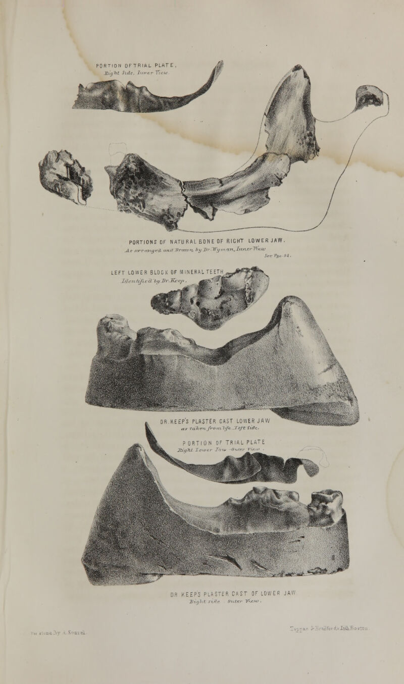 PORTION OFTRIAL PLATE tight Sl&e. Timer Ti'eu. PORTIONS OF NATURAL BONE OF RICHT LOWERJAVV. 1, rtrrmigca. mm Vroum. hy VrWym.on.InrLerVivw LEFT LOWER BLOCK OF MINERAL TEETH /,,;■„/,/,, ,i i,„ Vr.Zkep.
