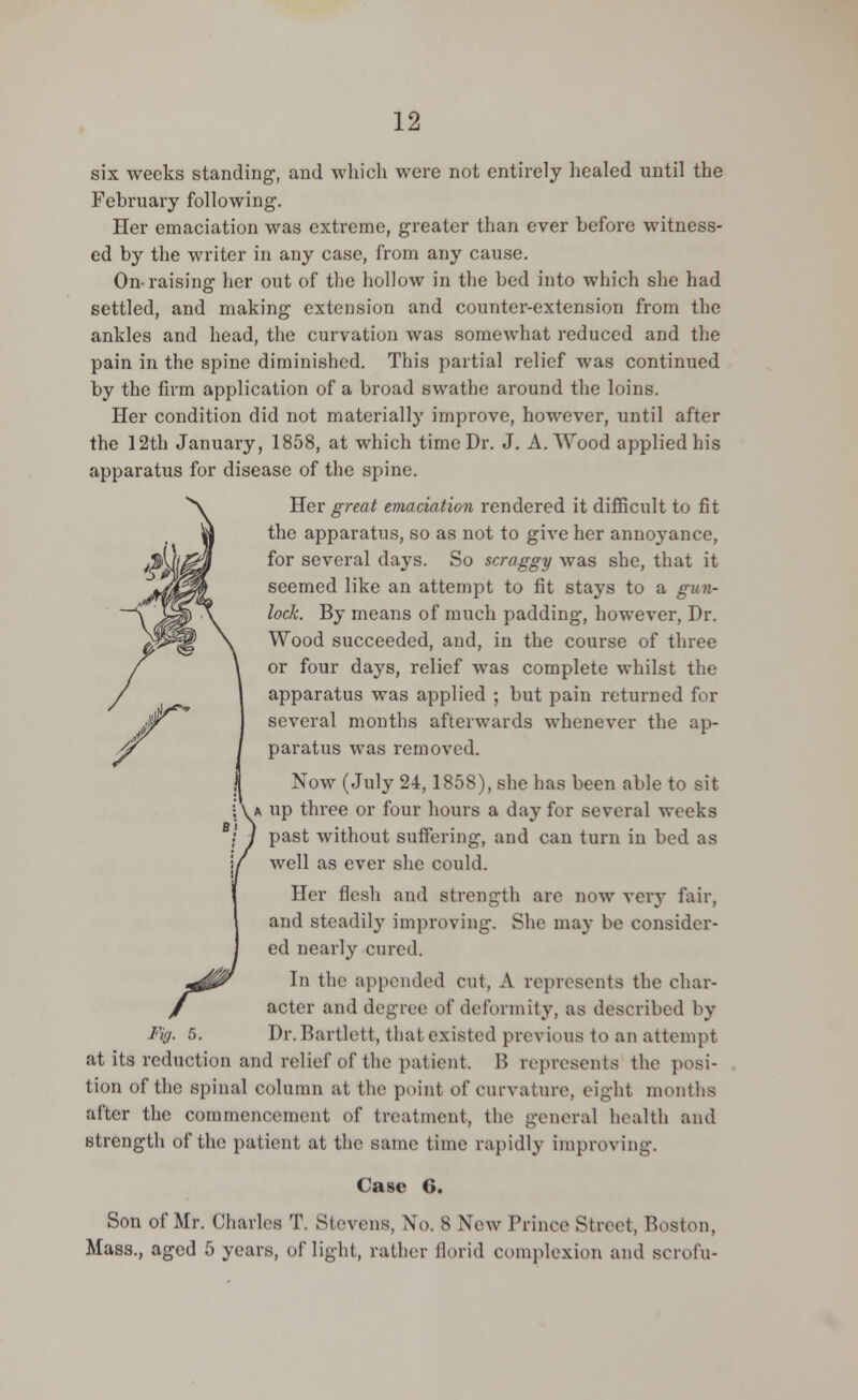 six weeks standing, and which were not entirely healed until the February following. Her emaciation was extreme, greater than ever before witness- ed by the writer in any case, from any cause. On-raising her out of the hollow in the bed into which she had settled, and making extension and counter-extension from the ankles and head, the curvation was somewhat reduced and the pain in the spine diminished. This partial relief was continued by the firm application of a broad swathe around the loins. Her condition did not materially improve, however, until after the 12th January, 1858, at which time Dr. J. A.Wood applied his apparatus for disease of the spine. Her great emaciation rendered it difficult to fit the apparatus, so as not to give her annoyance, for several days. So scraggy was she, that it seemed like an attempt to fit stays to a gun- lock. By means of much padding, however, Dr. Wood succeeded, and, in the course of three or four days, relief was complete whilst the apparatus was applied ; but pain returned for several months afterwards whenever the ap- paratus was removed. Now (July 24,1858), she has been able to sit ^a up three or four hours a day for several weeks past without suffering, and can turn in bed as well as ever she could. Her flesh and strength are now very fair, and steadily improving. She may be consider- ed nearly cured. In the appended cut, A represents the char- acter and degree1 of deformity, as described by Dr.Bartlett, that existed previous to an attempt at its reduction and relief of the patient. B represents the posi- tion of the spinal column at the point of curvature, eight months after the commencement of treatment, the general health and strength of the patient at the same time rapidly improving. Case 6. Son of Mr. Charles T. Stevens, No. 8 New Prince Street, Boston. Mass., aged 5 years, of light, rather florid complexion and scrofu- m '<!/■