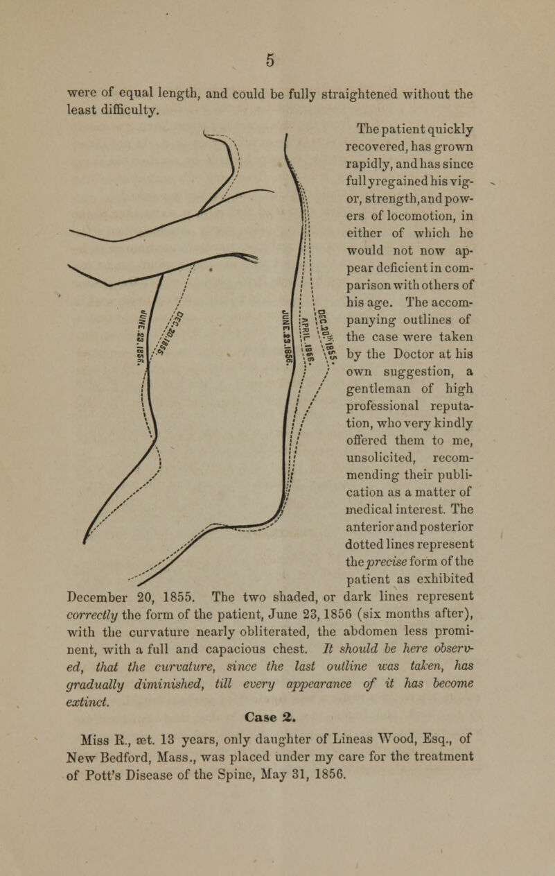 were of equal length, and could be fully straightened without the least difficulty. The patient quickly recovered, has grown rapidly, and has since full yregained his vig- or, strength,and pow- ers of locomotion, in either of which he would not now ap- pear deficient in com- parison with others of his age. The accom- panying outlines of the case were taken by the Doctor at his own suggestion, a gentleman of high professional reputa- tion, who very kindly offered them to me, unsolicited, recom- mending their publi- cation as a matter of medical interest. The anterior and posterior dotted lines represent the precise form of the patient as exhibited December 20, 1855. The two shaded, or dark lines represent correctly the form of the patient, June 23,1856 (six months after), with the curvature nearly obliterated, the abdomen less promi- nent, with a full and capacious chest. It should he here observ- ed, that the curvature, since the last outline was taken, has gradually diminished, till every appearance of it has become extinct. Case H. Miss R., aet. 13 years, only daughter of Lineas Wood, Esq., of New Bedford, Mass., was placed under my care for the treatment of Pott's Disease of the Spiue, May 31, 1856.