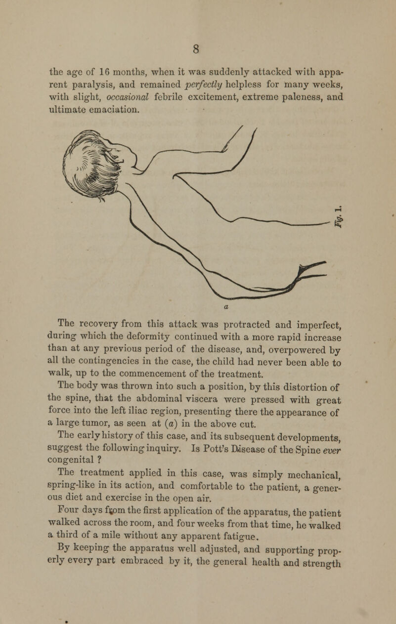 the age of 16 months, when it was suddenly attacked with appa- rent paralysis, and remained perfectly helpless for many weeks, with slight, occasional febrile excitement, extreme paleness, and ultimate emaciation. ^ The recovery from this attack was protracted and imperfect, during which the deformity continued with a more rapid increase than at any previous period of the disease, and, overpowered by all the contingencies in the case, the child had never been able to walk, up to the commencement of the treatment. The body was thrown into such a position, by this distortion of the spine, that the abdominal viscera were pressed with great force into the left iliac region, presenting there the appearance of a large tumor, as seen at (a) in the above cut. The earlyhistoryof this case, and its subsequent developments, suggest the following inquiry. Is Pott's D.isease of the Spine ever congenital ? The treatment applied in this case, was simply mechanical, spring-like in its action, and comfortable to the patient, a gener- ous diet and exercise in the open air. Four days f^om the first application of the apparatus, the patient walked across the room, and four weeks from that time, he walked a third of a mile without any apparent fatigue. By keeping the apparatus well adjusted, and supporting prop- erly every part embraced by it, the general health and strength