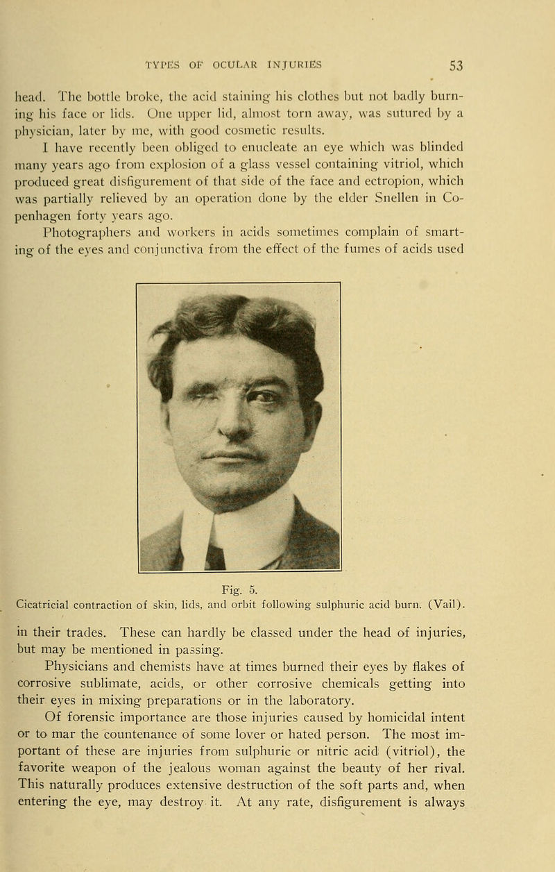 head. The bottle broke, the acid staining his clothes but not badly burn- ing his lace or lids. One upper lid, almost torn away, was sutured by a physician, later by me, with good cosmetic results. I have recently been obliged to enucleate an eye which was blinded many years ago from explosion of a glass vessel containing vitriol, which produced great disfigurement of that side of the face and ectropion, which was partially relieved by an operation done by the elder Snellen in Co- penhagen forty years ago. Photographers and workers in acids sometimes complain of smart- ing of the eves and conjunctiva from the effect of the fumes of acids used Fig. 5. Cicatricial contraction of skin, lids, and orbit following sulphuric acid burn. (Vail). in their trades. These can hardly be classed under the head of injuries, but may be mentioned in passing. Physicians and chemists have at times burned their eyes by flakes of corrosive sublimate, acids, or other corrosive chemicals getting into their eyes in mixing preparations or in the laboratory. Of forensic importance are those injuries caused by homicidal intent or to mar the countenance of some lover or hated person. The most im- portant of these are injuries from sulphuric or nitric acid (vitriol), the favorite weapon of the jealous woman against the beauty of her rival. This naturally produces extensive destruction of the soft parts and, when entering the eye, may destroy it. At any rate, disfigurement is always