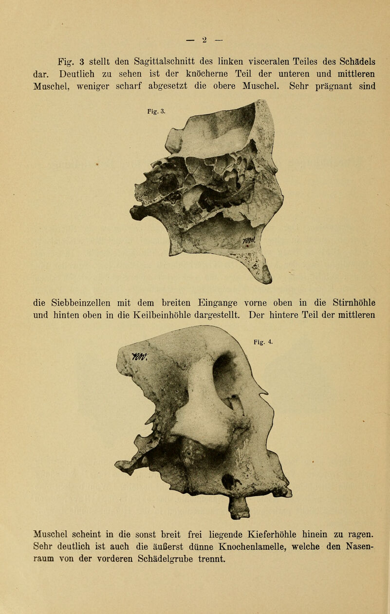 Fig. 3 stellt den Sagittalschnitt des linken visceralen Teiles des Schädels dar. Deutlich zu sehen ist der knöcherne Teil der unteren und mittleren Muschel, weniger scharf abgesetzt die obere Muschel. Sehr prägnant sind die Siebbeinzellen mit dem breiten Eingange vorne oben in die Stirnhöhle und hinten oben in die Keilbeinhöhle dargestellt. Der hintere Teil der mittleren \ Fig. 4. Muschel scheint in die sonst breit frei liegende Kieferhöhle hinein zu ragen. Sehr deutlich ist auch die äußerst dünne Knochenlamelle, welche den Nasen- raum von der vorderen Schädelgrube trennt.