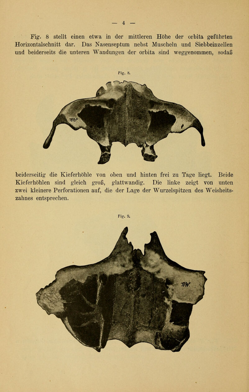 Fig. 8 stellt einen etwa in der mittleren Höhe der orbita geführten Horizontalschnitt dar. Das Nasenseptum nebst Muscheln und Siebbeinzellen und beiderseits die unteren Wandungen der orbita sind weggenommen, sodaß Fig. 8. beiderseitig die Kieferhöhle von oben und hinten frei zu Tage liegt. Beide Kieferhöhlen sind gleich groß, glattwandig. Die linke zeigt von unten zwei kleinere Perforationen auf, die der Lage der Wurzelspitzen des Weisheits- zahnes entsprechen. Fie. 9.