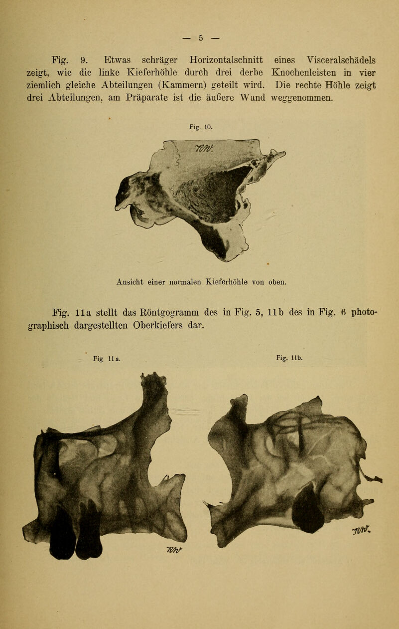 Fig. 9. Etwas schräger Horizontalschnitt eines Visceralschädels zeigt, wie die linke Kieferhöhle durch drei derbe Knochenleisten in vier ziemlich gleiche Abteilungen (Kammern) geteilt wird. Die rechte Höhle zeigt drei Abteilungen, am Präparate ist die äußere Wand weggenommen. Fig. 10. Ansicht einer normalen Kieferhöhle von oben. Fig. IIa stellt das Röntgogramm des in Fig. 5, IIb des in Fig. 6 photo- graphisch dargestellten Oberkiefers dar. Fig IIa. Fig. IIb.