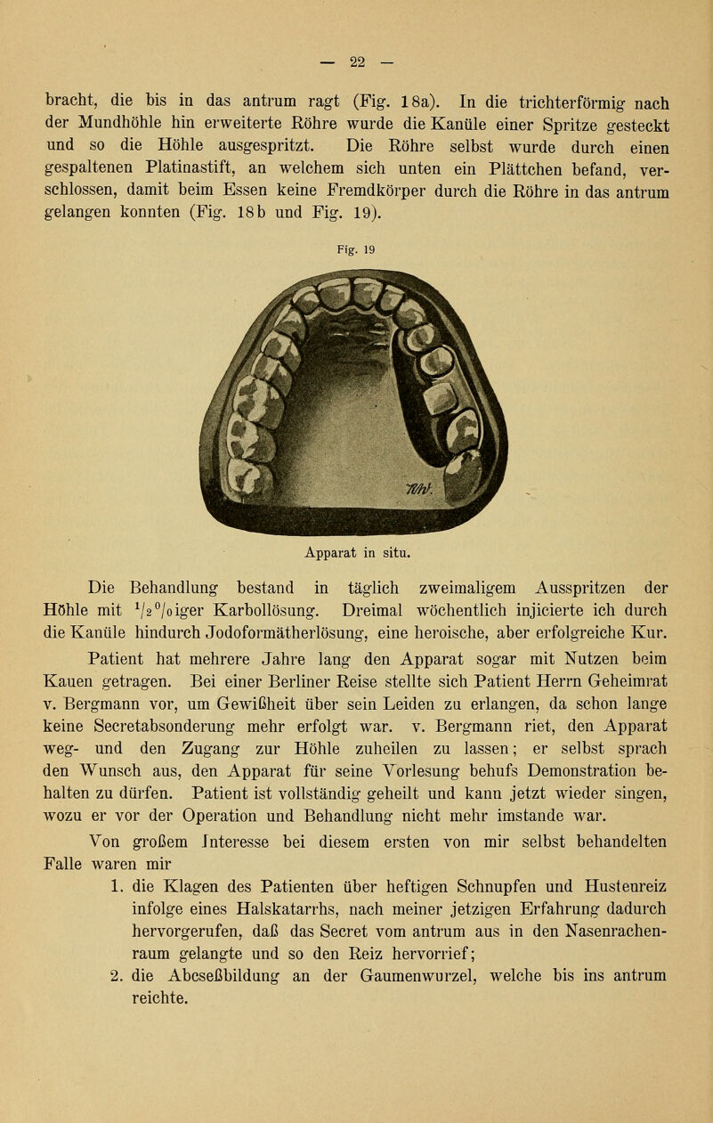 bracht, die bis in das antrum ragt (Fig. 18a). In die trichterförmig- nach der Mundhöhle hin erweiterte Röhre wurde die Kanüle einer Spritze gesteckt und so die Höhle ausgespritzt. Die Röhre selbst wurde durch einen gespaltenen Piatinastift, an welchem sieh unten ein Plättchen befand, ver- schlossen, damit beim Essen keine Fremdkörper durch die Röhre in das antrum gelangen konnten (Fig. 18 b und Fig. 19). Fig. 19 Apparat in situ. Die Behandlung bestand in täglich zweimaligem Ausspritzen der Höhle mit ^/2°/oiger Karbollösung. Dreimal wöchentlich injicierte ich durch die Kanüle hindurch Jodoformätherlösung, eine heroische, aber erfolgreiche Kur. Patient hat mehrere Jahre lang den Apparat sogar mit Nutzen beim Kauen getragen. Bei einer Berliner Reise stellte sich Patient Herrn Geheimrat V. Bergmann vor, um Gewißheit über sein Leiden zu erlangen, da schon lange keine Secretabsonderung mehr erfolgt war. v. Bergmann riet, den Apparat weg- und den Zugang zur Höhle zuheilen zu lassen; er selbst sprach den Wunsch aus, den Apparat für seine Vorlesung behufs Demonstration be- halten zu dürfen. Patient ist vollständig geheilt und kann jetzt wieder singen, wozu er vor der Operation und Behandlung nicht mehr imstande war. Von großem Interesse bei diesem ersten von mir selbst behandelten Falle waren mir 1. die Klagen des Patienten über heftigen Schnupfen und Hustenreiz infolge eines Halskatarrhs, nach meiner jetzigen Erfahrung dadurch hervorgerufen, daß das Secret vom antrum aus in den Nasenrachen- raum gelangte und so den Reiz hervorrief; 2. die Abcseßbildung an der Gaumenwurzel, welche bis ins antrum reichte.