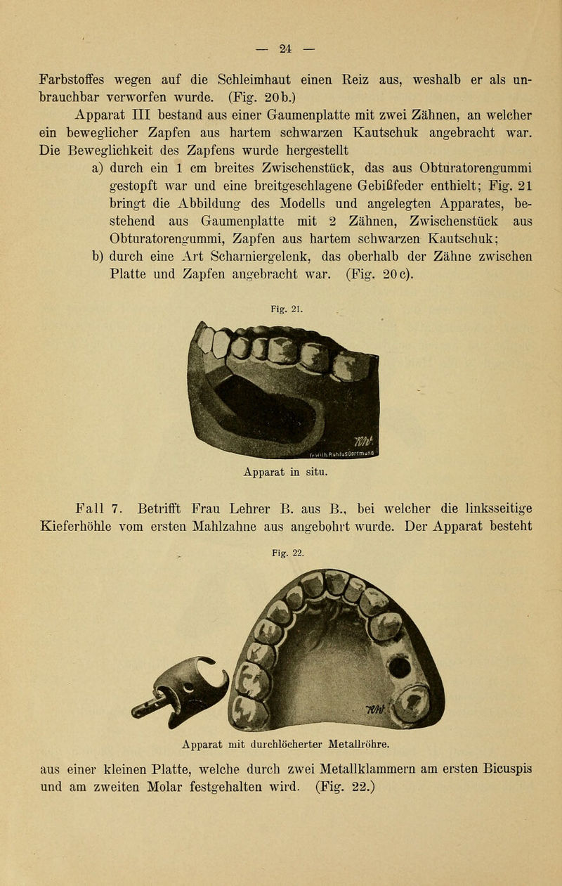 Farbstoffes wegen auf die Schleimhaut einen Reiz aus, weshalb er als un- brauchbar verworfen wurde. (Fig. 20 b.) Apparat III bestand aus einer Gaumenplatte mit zwei Zähnen, an welcher ein beweglicher Zapfen aus hartem schwarzen Kautschuk angebracht war. Die Beweglichkeit des Zapfens wurde hergestellt a) durch ein 1 cm breites Zwischenstück, das aus Obturatorengummi gestopft war und eine breitgeschlagene Gebißfeder enthielt; Fig. 21 bringt die Abbildung des Modells und angelegten Apparates, be- stehend aus Gaumenplatte mit 2 Zähnen, Zwischenstück aus Obturatorengummi, Zapfen aus hartem schwarzen Kautschuk; b) durch eine Art Scharniergelenk, das oberhalb der Zähne zwischen Platte und Zapfen angebracht war. (Fig. 20 c). Fig. 21. Apparat in situ. Fall 7. Betrifft Frau Lehrer B. aus B., bei welcher die linksseitige Kieferhöhle vom ersten Mahlzahne aus angebohrt wurde. Der Apparat besteht Fig. 22. Apparat mit durchlöcherter Metailröhre. aus einer kleinen Platte, welche durch zwei Metallklammern am ersten Bicuspis und am zweiten Molar festgehalten wird. (Fig. 22.)