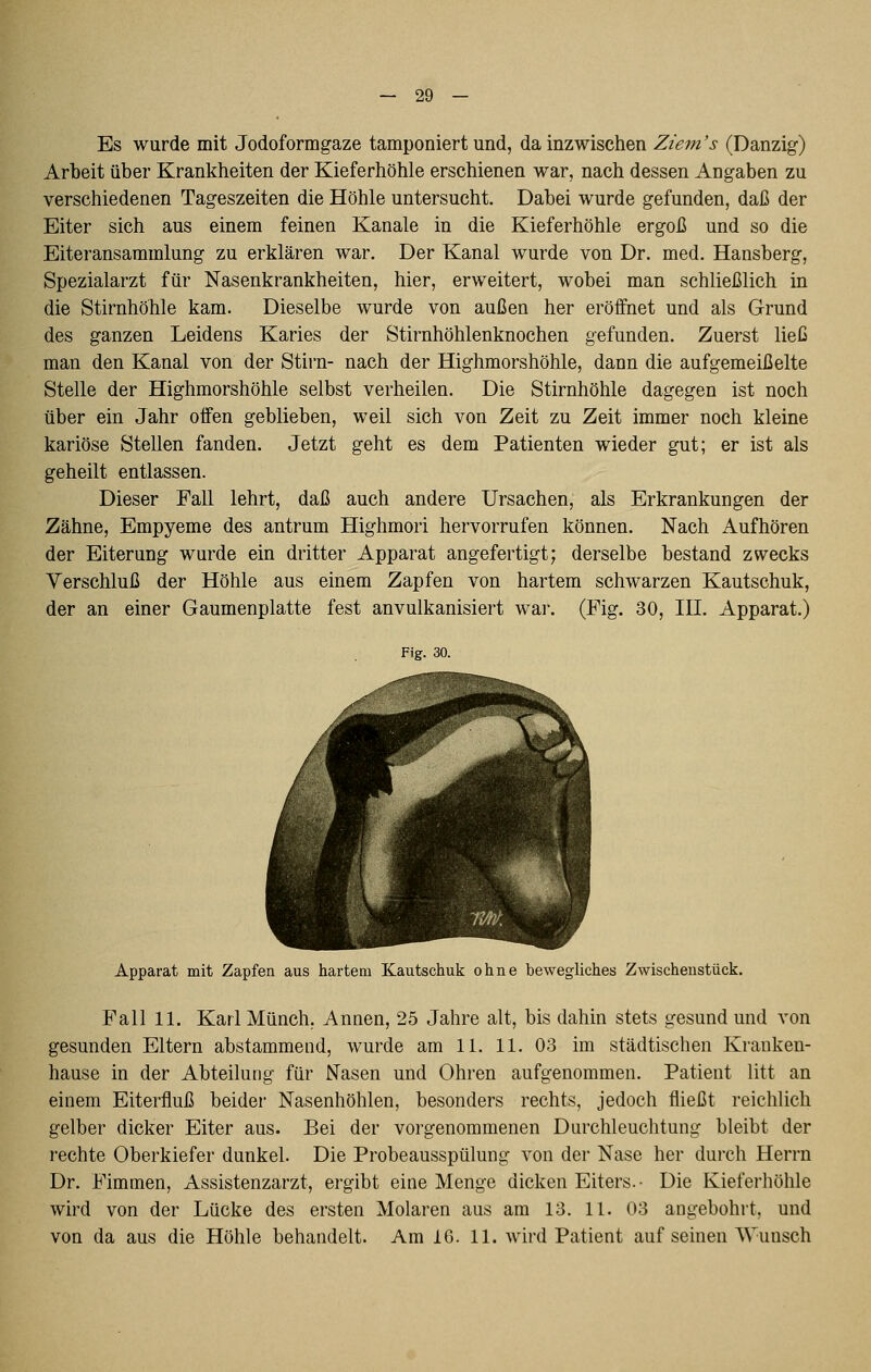 Es wurde mit Jodoformgaze tamponiert und, da inzwischen Ziem's (Danzig) Arbeit über Krankheiten der Kieferhöhle erschienen war, nach dessen Angaben zu verschiedenen Tageszeiten die Höhle untersucht. Dabei wurde gefunden, daß der Eiter sich aus einem feinen Kanäle in die Kieferhöhle ergoß und so die Eiteransammlung zu erklären war. Der Kanal wurde von Dr. med, Hansberg, Spezialarzt für Nasenkrankheiten, hier, erweitert, wobei man schließlich in die Stirnhöhle kam. Dieselbe wurde von außen her eröffnet und als Grund des ganzen Leidens Karies der Stirnhöhlenknochen gefunden. Zuerst ließ man den Kanal von der Stirn- nach der Highmorshöhle, dann die aufgemeißelte Stelle der Highmorshöhle selbst verheilen. Die Stirnhöhle dagegen ist noch über ein Jahr offen geblieben, weil sich von Zeit zu Zeit immer noch kleine kariöse Stellen fanden. Jetzt geht es dem Patienten wieder gut; er ist als geheilt entlassen. Dieser Fall lehrt, daß auch andere Ursachen, als Erkrankungen der Zähne, Empyeme des antrum Highmori hervorrufen können. Nach Aufhören der Eiterung wurde ein dritter Apparat angefertigt; derselbe bestand zwecks Verschluß der Höhle aus einem Zapfen von hartem schwarzen Kautschuk, der an einer Gaumenplatte fest anvulkanisiert war. (Fig. 30, IE. Apparat.) Figf. 30. Apparat mit Zapfen aus hartem Kautschuk ohne bewegliches Zwischenstück. Fall 11. Karl Münch, Annen, 25 Jahre alt, bis dahin stets gesund und von gesunden Eltern abstammend, wurde am 11. 11. 03 im städtischen Kranken- hause in der Abteilung für Nasen und Ohren aufgenommen. Patient litt an einem Eiterfluß beider Nasenhöhlen, besonders rechts, jedoch fließt reichlich gelber dicker Eiter aus. Bei der vorgenommenen Durchleuchtung bleibt der rechte Oberkiefer dunkel. Die Probeausspülung von der Nase her durch Herrn Dr. Fimmen, Assistenzarzt, ergibt eine Menge dicken Eiters.- Die Kieferhöhle wird von der Lücke des ersten Molaren aus am 13. 11. 03 angebohrt, und von da aus die Höhle behandelt. Am 16. 11. wird Patient auf seinen AVunsch