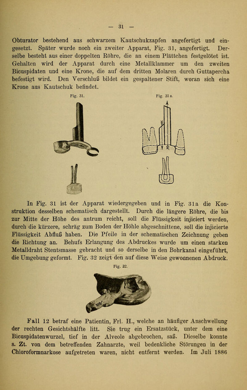 Obturator bestehend aus schwarzem Kautschukzapfen angefertigt und ein- gesetzt. Später wurde noch ein zweiter Apparat, Fig. 31, angefertigt. Der- selbe besteht aus einer doppelten Röhre, die an einem Plättchen festgelötet ist. Gehalten wird der Apparat durch eine Metallklammer um den zweiten Bicuspidaten und eine Krone, die auf dem dritten Molaren durch Guttapercha befestigt wird. Den Verschluß bildet ein gespaltener Stift, woran sich eine Krone aus Kautschuk befindet. Fig. 31. In Fig. 31 ist der Apparat wiedergegeben und in Fig. 31a die Kon- struktion desselben schematisch dargestellt. Durch die längere Röhre, die bis zur Mitte der Höhe des antrum reicht, soll die Flüssigkeit injiciert werden, durch die kürzere, schräg zum Boden der Höhle abgeschnittene, soll die injicierte Flüssigkeit Abfluß haben. Die Pfeile in der schematischen Zeichnung geben die Richtung an. Behufs Erlangung des Abdruckes wurde um einen starken Metalldraht Stentsmasse gebracht und so derselbe in den Bohrkanal eingeführt, die Umgebung geformt. Fig. 32 zeigt den auf diese Weise gewonnenen Abdruck. Fig. 32. Fall 12 betraf eine Patientin, Frl. H., welche an häufiger Anschwellung der rechten Gesichtshälfte litt. Sie trug ein Ersatzstück, unter dem eine Bicuspidatenwurzel, tief in der Alveole abgebrochen, saß. Dieselbe konnte s. Zt. von dem betreöenden Zahnarzte, weil bedenkliche Störungen in der Chloroformnarkose aufgetreten waren, nicht entfernt werden. Im Juli 1886