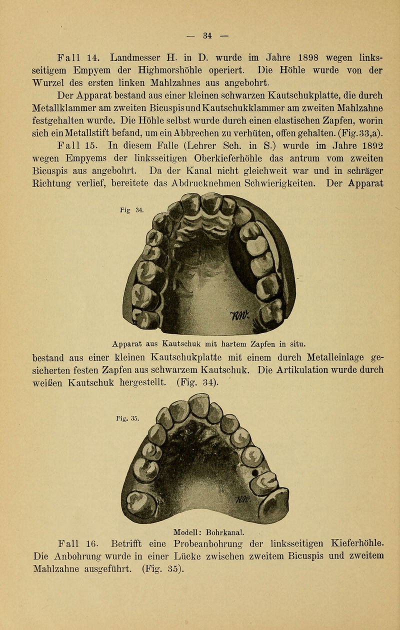 Fall 14. Landmesser H. in D. wurde im Jahre 1898 weg-en links- seitigem Empyem der Highmorsliöhle operiert. Die Höhle wurde von der Wurzel des ersten linken Mahlzahnes aus ang-ebohrt. Der Apparat bestand aus einer kleinen schwarzen Kautschukplatte, die durch Metallklammer am zweiten ßicuspis und Kautschukklammer am zweiten Mahlzahne festgehalten wurde. Die Höhle selbst wurde durch einen elastischen Zapfen, worin sich ein Metallstift befand, um ein Abbrechen zu verhüten, offen gehalten. (Fig.33,a). Fall 15. In diesem Falle (Lehrer Seh. in S.) wurde im Jahre 1892 wegen Empyems der linksseitigen Oberkieferhöhle das antrum vom zweiten Bicuspis aus angebohrt. Da der Kanal nicht gleichweit war und in schräger Richtung verlief, bereitete das Abdrucknehmen Schwierigkeiten. Der Apparat Fig 34. Apparat aus Kautschuk mit hartem Zapfen in situ. bestand aus einer kleinen Kautschukplatte mit einem durch Metalleinlage ge- sicherten festen Zapfen aus schwarzem Kautschuk. Die Artikulation wurde durch weißen Kautschuk hergestellt. (Fig. .34). Fig. 35, Modell: Bohrkanal. Fall 16. Betrifft eine Probeanbohrung der linksseitigen Kieferhöhle. Die Anbohrung wurde in einer Lücke zwischen zweitem Bicuspis und zweitem Mahlzahne ausgeführt. (Fig. 35).